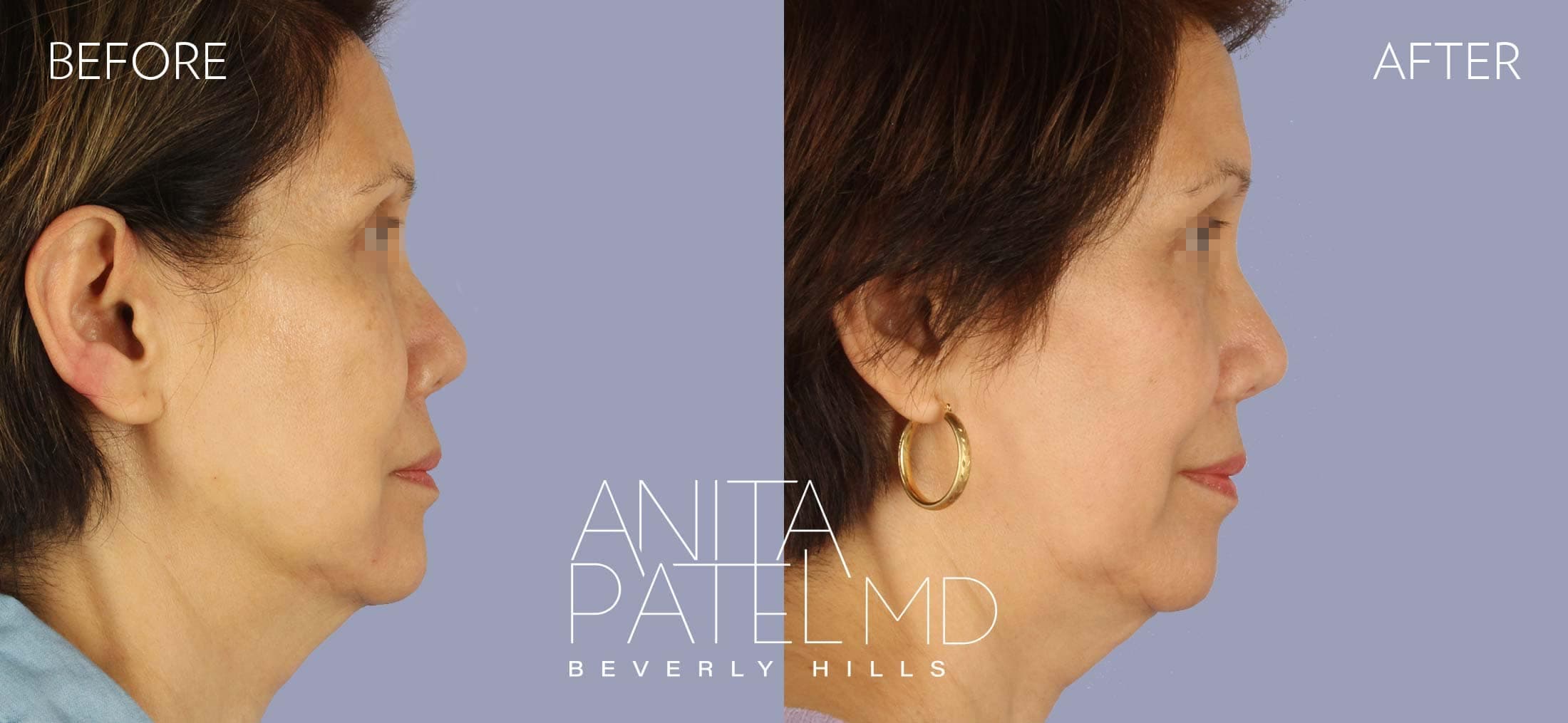 IPL Photofacial before and after — Patient 4, photo 3 of 4 — Dr. Anita Patel, MD, FACS, Beverly Hills