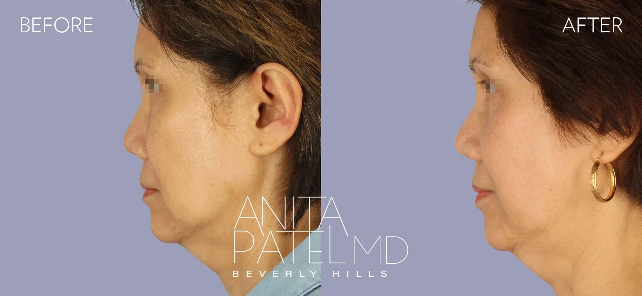 IPL Photofacial before and after — Patient 4, photo 4 of 4 — Dr. Anita Patel, MD, FACS, Beverly Hills