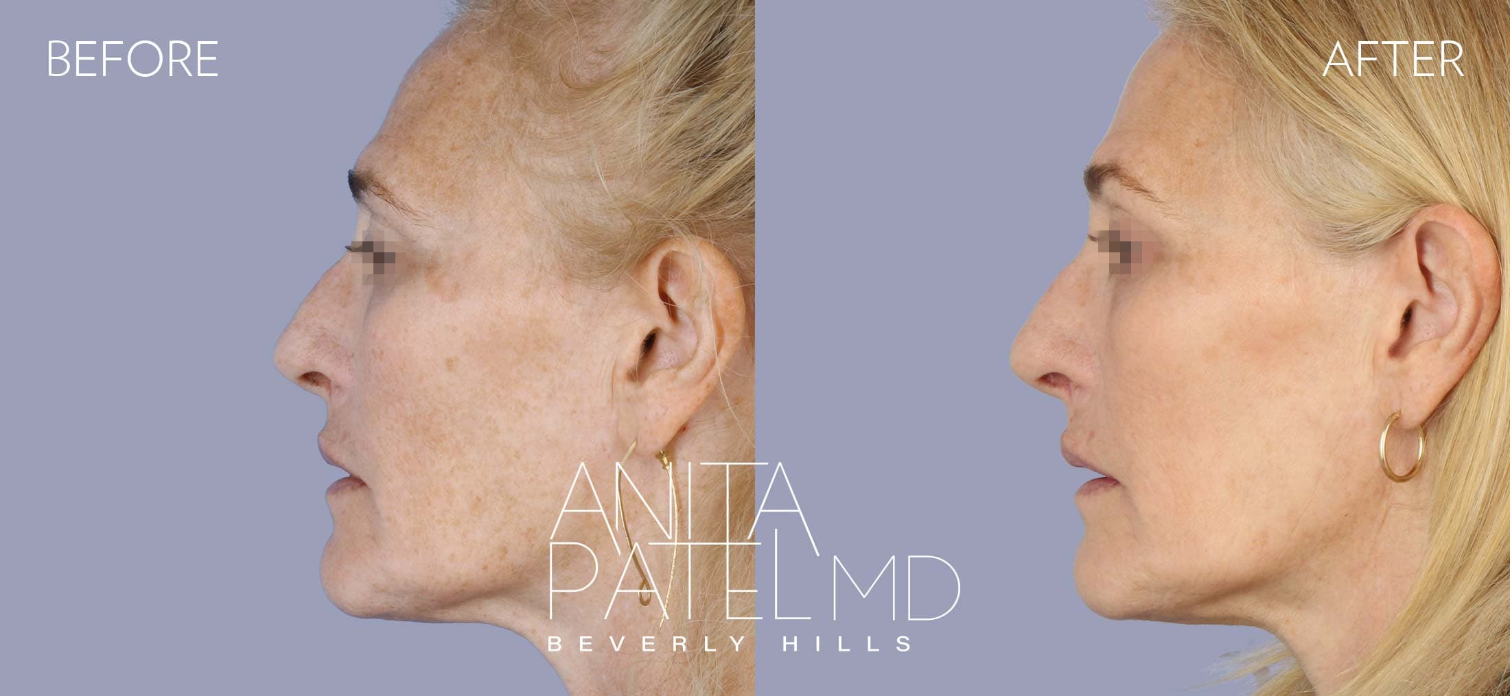 IPL Photofacial before and after — Patient 9, photo 1 of 5 — Dr. Anita Patel, MD, FACS, Beverly Hills