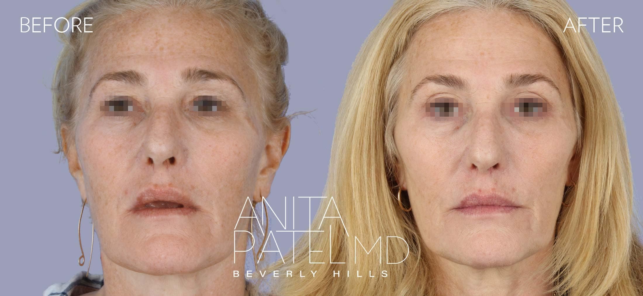 IPL Photofacial before and after — Patient 9, photo 2 of 5 — Dr. Anita Patel, MD, FACS, Beverly Hills