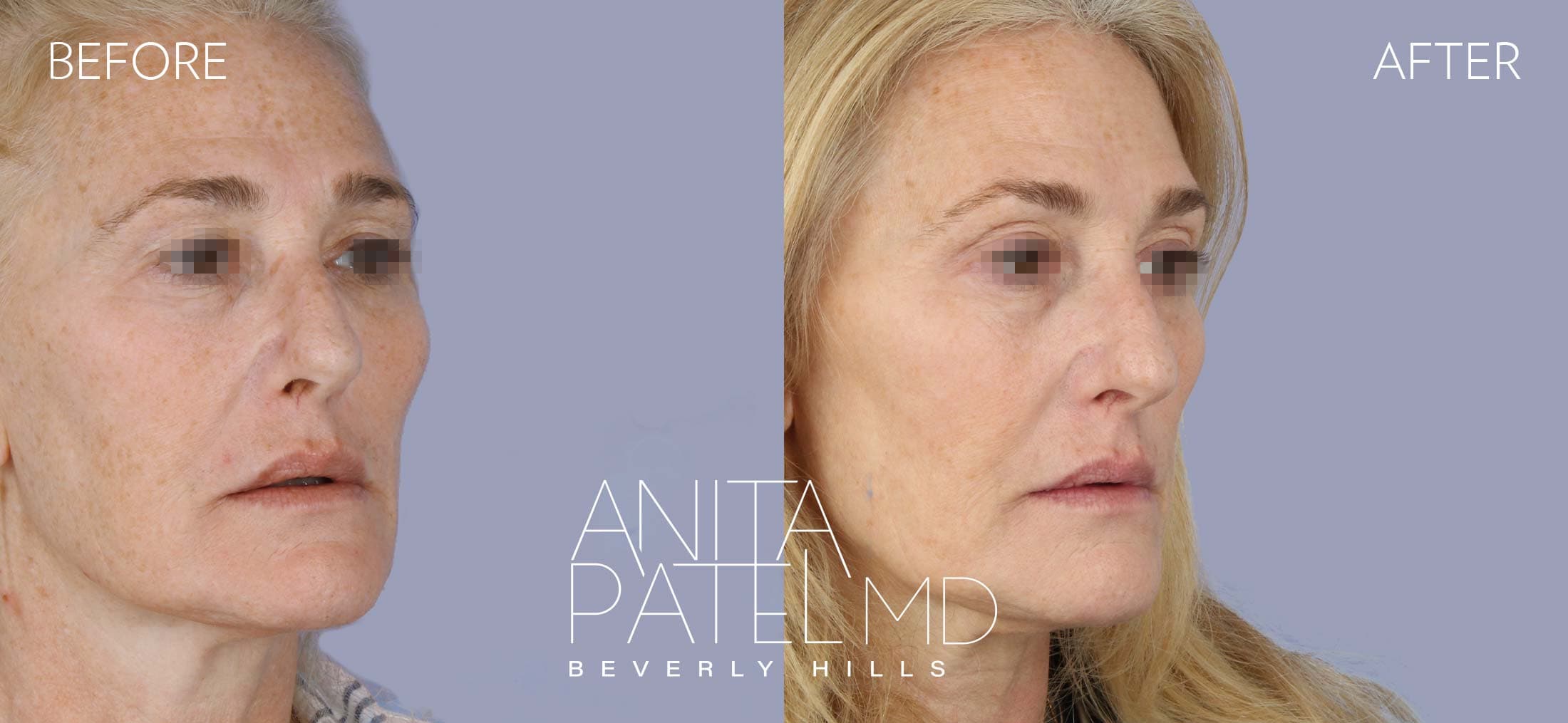 IPL Photofacial before and after — Patient 9, photo 3 of 5 — Dr. Anita Patel, MD, FACS, Beverly Hills