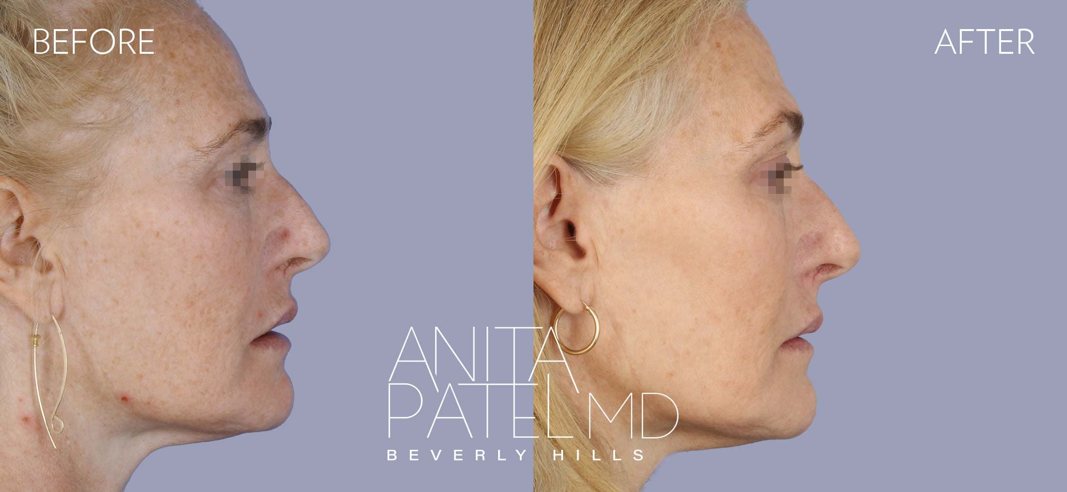 IPL Photofacial before and after — Patient 9, photo 4 of 5 — Dr. Anita Patel, MD, FACS, Beverly Hills