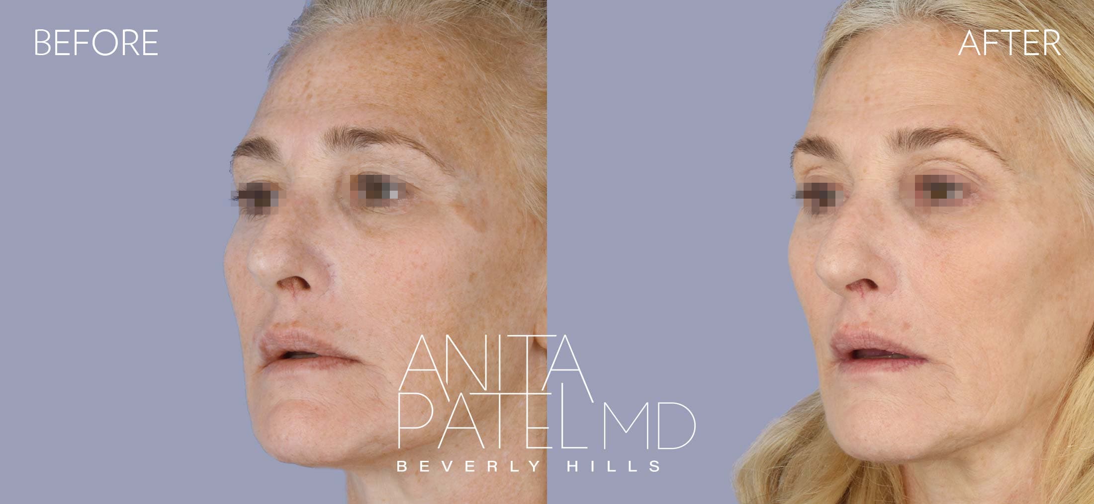 IPL Photofacial before and after — Patient 9, photo 5 of 5 — Dr. Anita Patel, MD, FACS, Beverly Hills