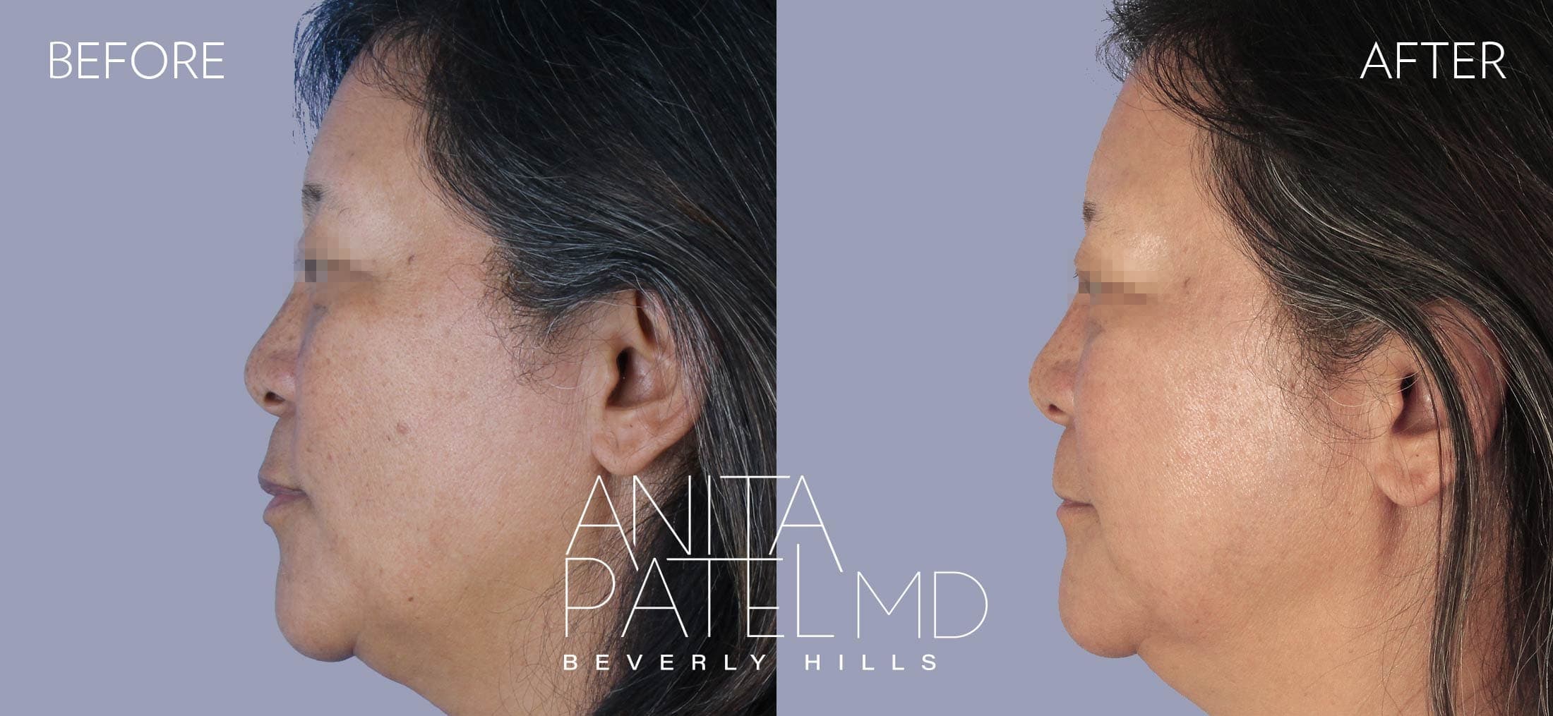 IPL Photofacial before and after — Patient 6, photo 2 of 4 — Dr. Anita Patel, MD, FACS, Beverly Hills