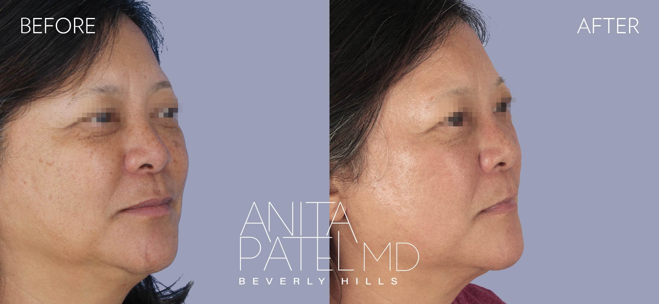 IPL Photofacial before and after — Patient 6, photo 3 of 4 — Dr. Anita Patel, MD, FACS, Beverly Hills