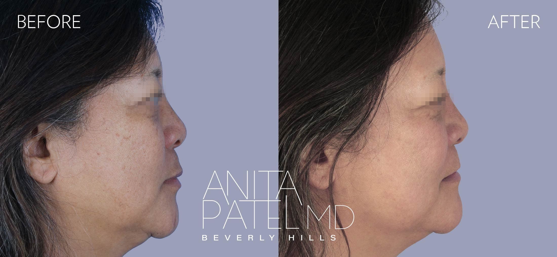 IPL Photofacial before and after — Patient 6, photo 4 of 4 — Dr. Anita Patel, MD, FACS, Beverly Hills