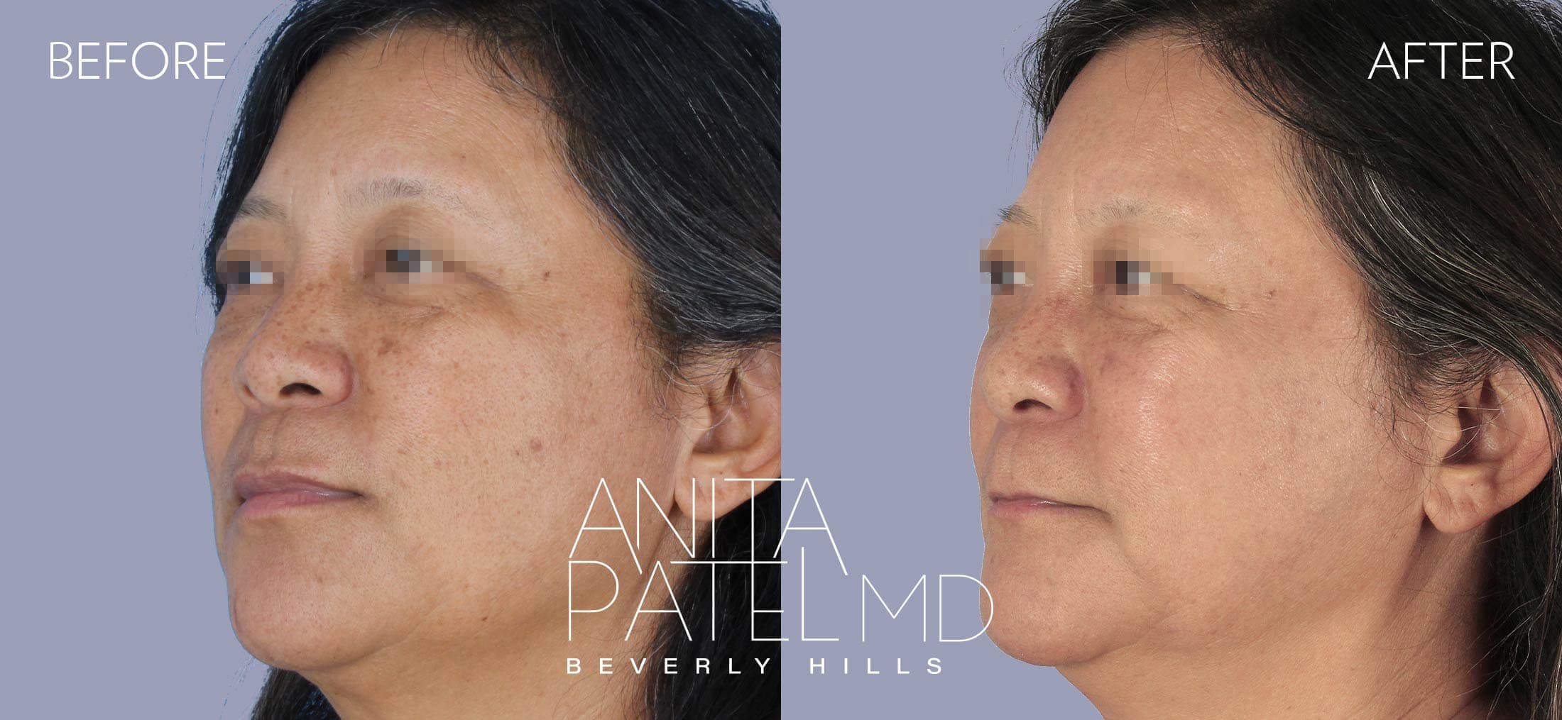 IPL Photofacial before and after — Patient 6, photo 1 of 4 — Dr. Anita Patel, MD, FACS, Beverly Hills