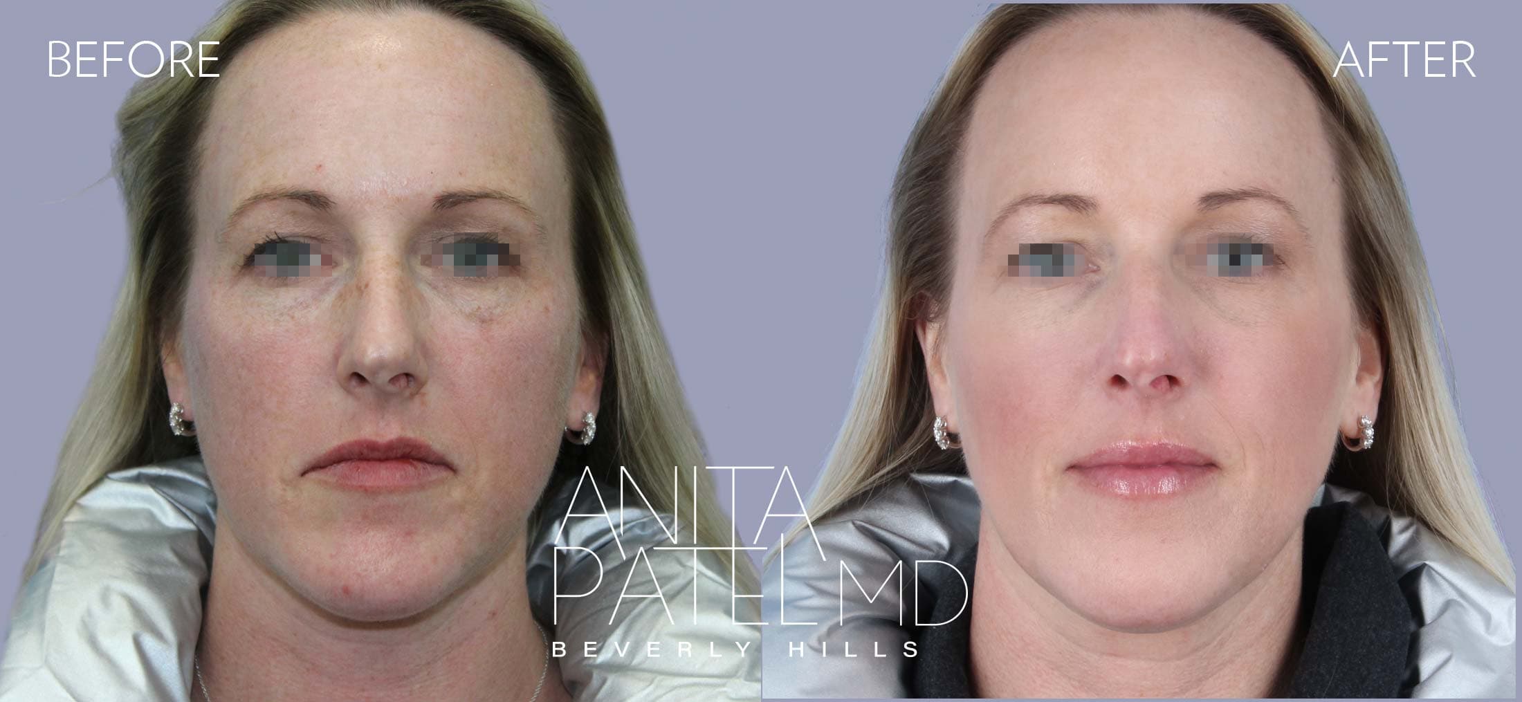 IPL Photofacial before and after — Patient 7, photo 1 of 5 — Dr. Anita Patel, MD, FACS, Beverly Hills
