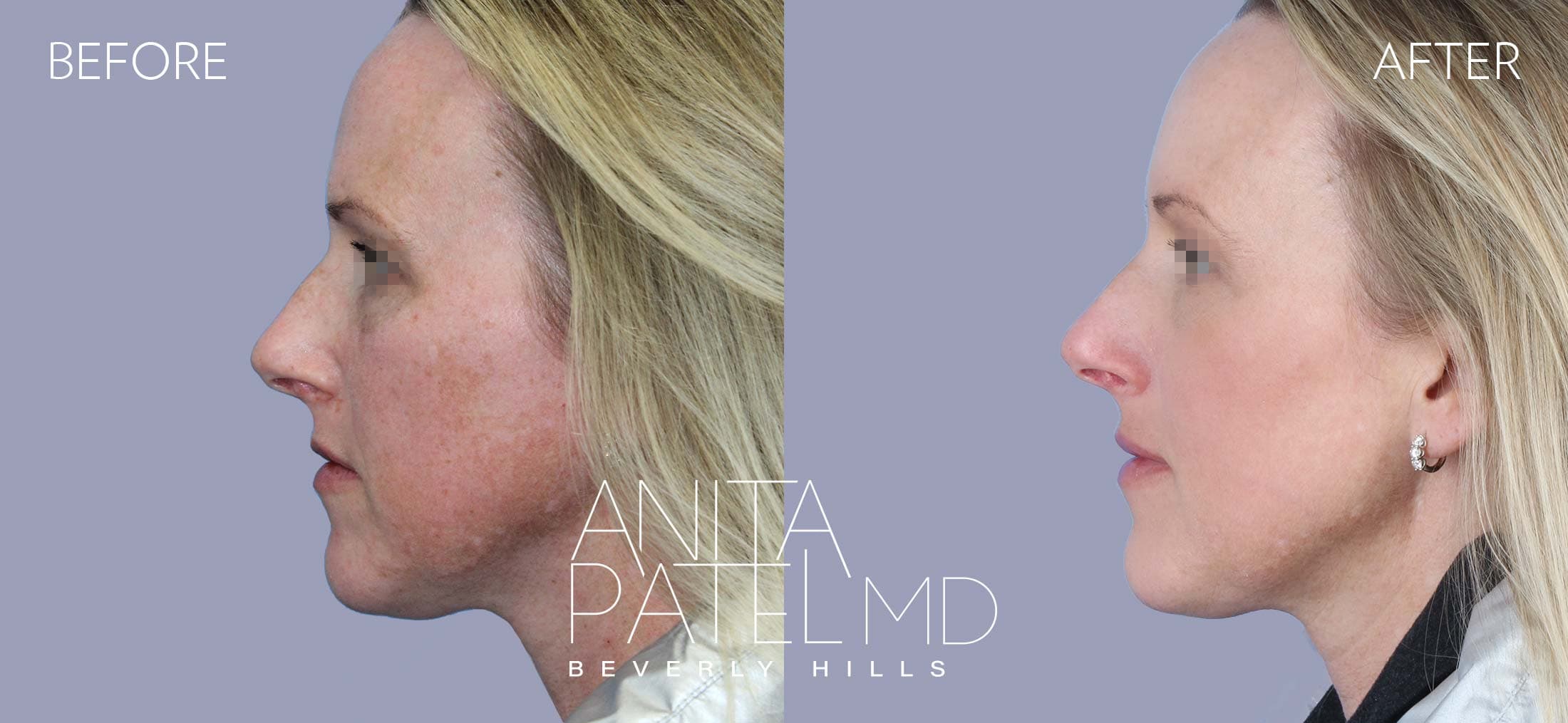 IPL Photofacial before and after — Patient 7, photo 2 of 5 — Dr. Anita Patel, MD, FACS, Beverly Hills