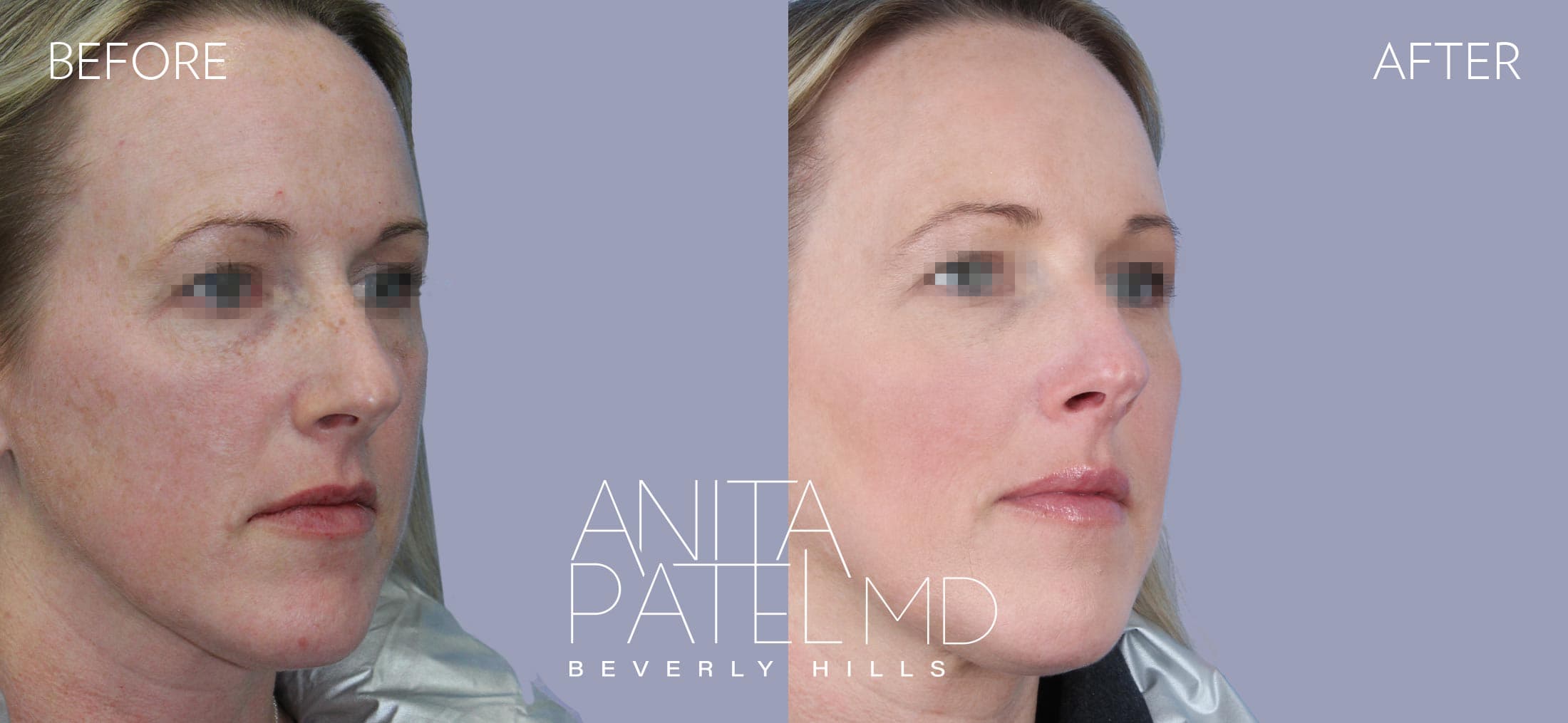 IPL Photofacial before and after — Patient 7, photo 3 of 5 — Dr. Anita Patel, MD, FACS, Beverly Hills