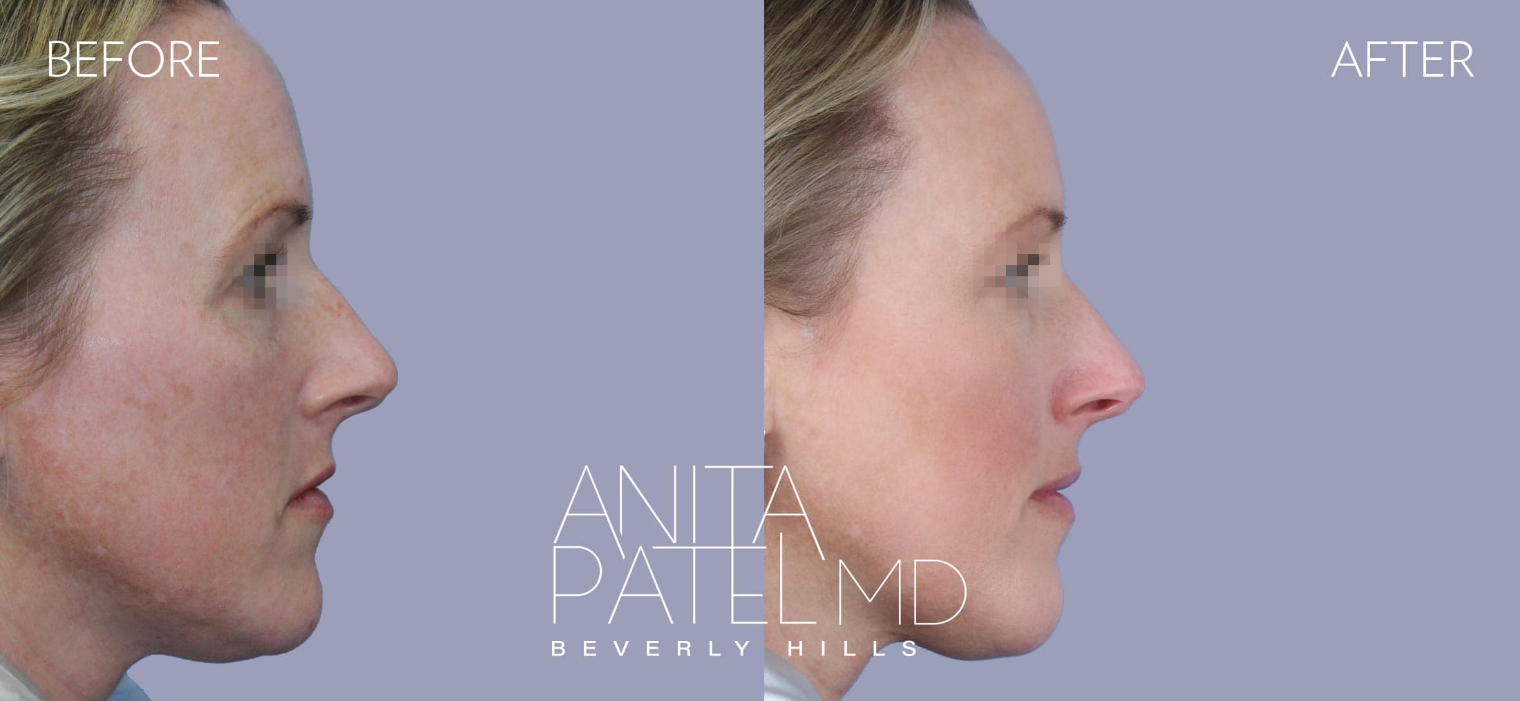IPL Photofacial before and after — Patient 7, photo 4 of 5 — Dr. Anita Patel, MD, FACS, Beverly Hills