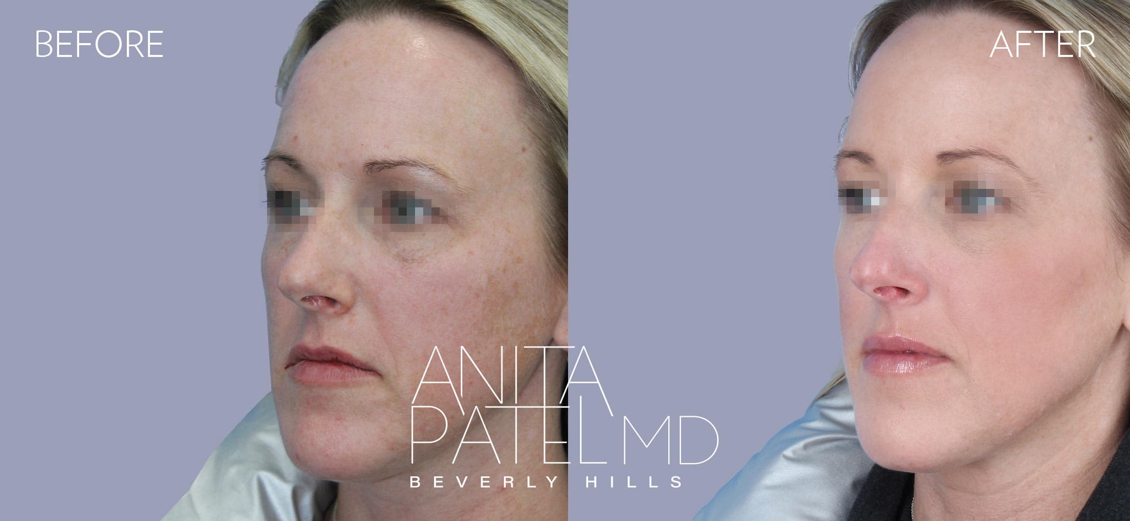IPL Photofacial before and after — Patient 7, photo 5 of 5 — Dr. Anita Patel, MD, FACS, Beverly Hills