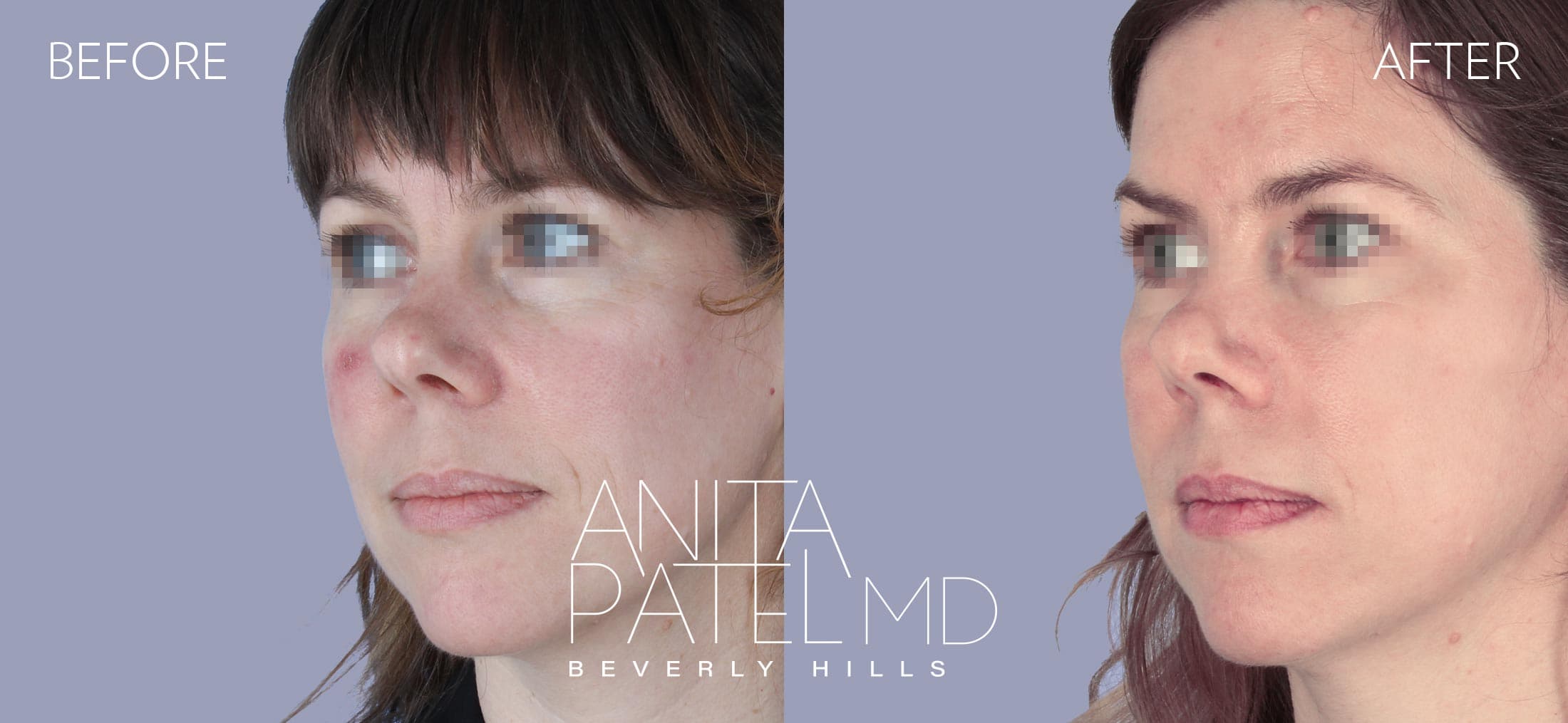 IPL Photofacial before and after — Patient 8, photo 5 of 5 — Dr. Anita Patel, MD, FACS, Beverly Hills