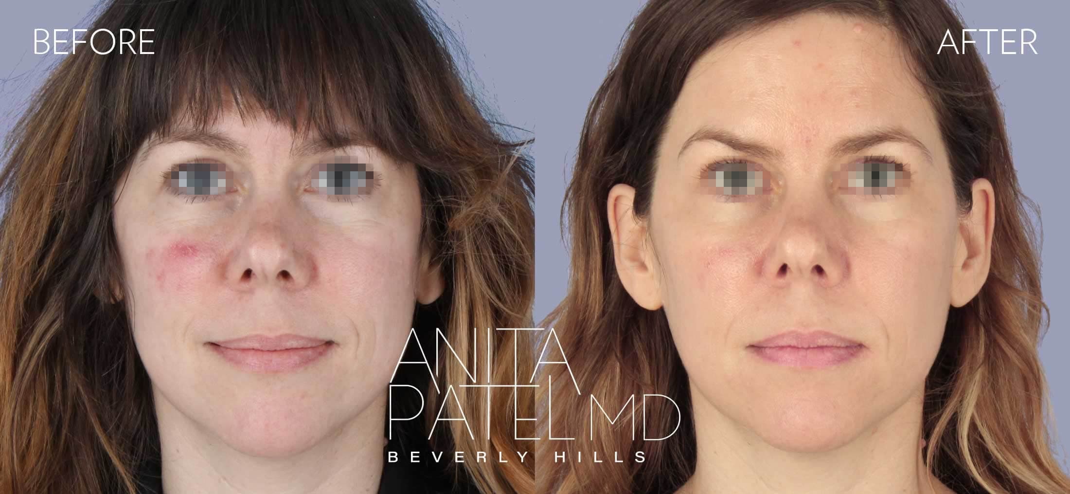 IPL Photofacial before and after — Patient 8, photo 1 of 5 — Dr. Anita Patel, MD, FACS, Beverly Hills