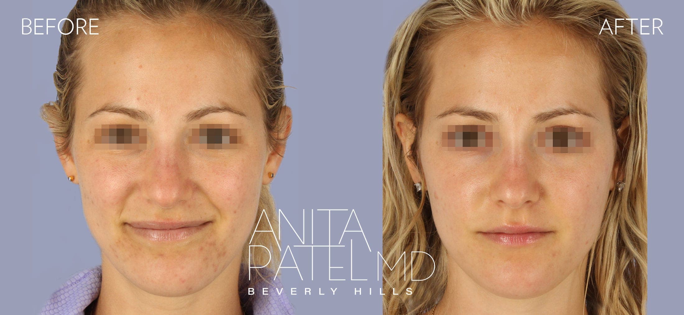 IPL Photofacial before and after — Dr. Anita Patel, Beverly Hills