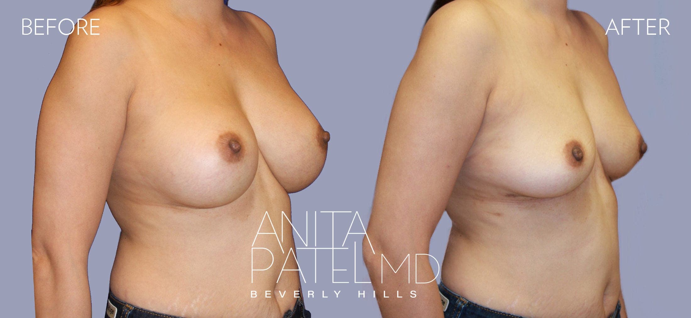 Breast Implant Removal before and after — Patient 1 — Dr. Anita Patel, MD, FACS, Beverly Hills