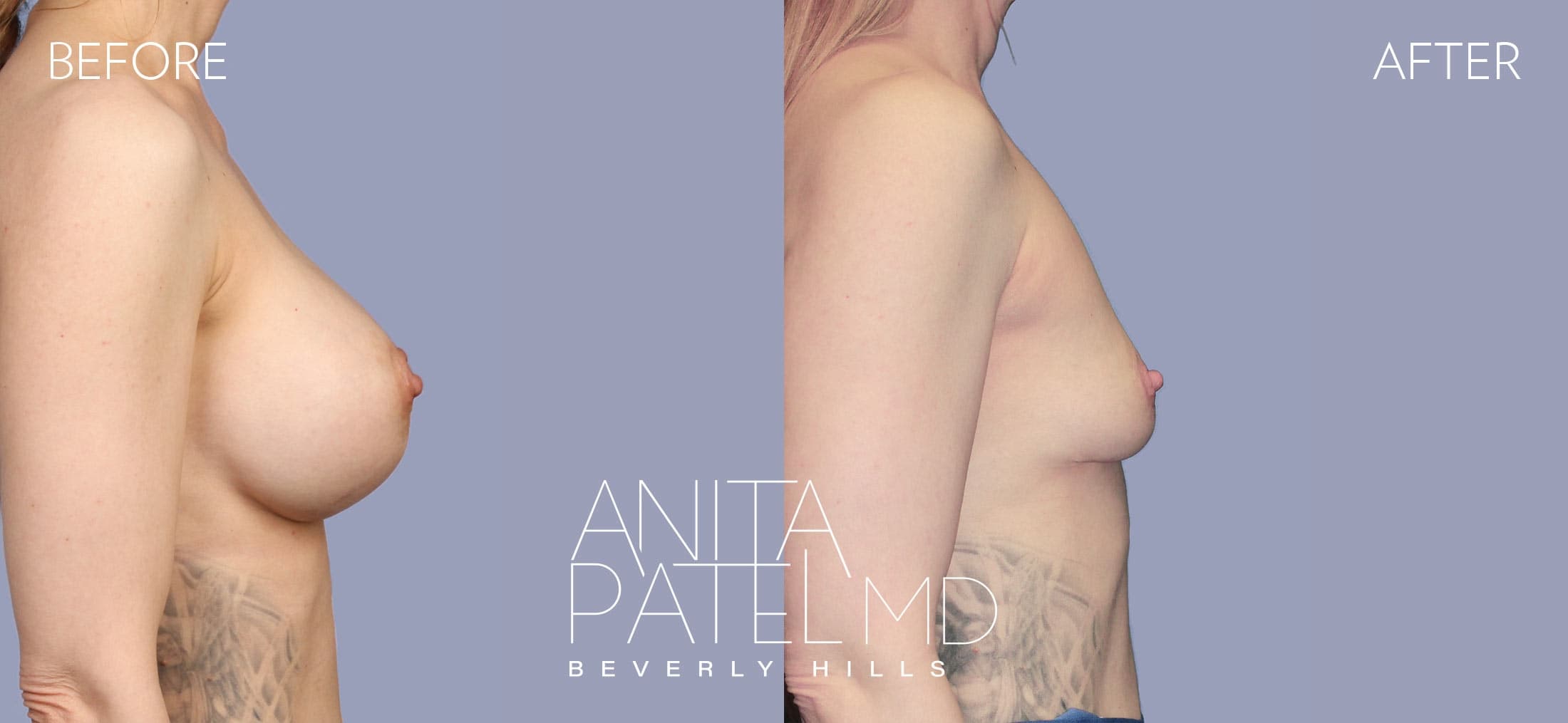 Breast Implant Removal before and after — Patient 3, photo 2 of 4 — Dr. Anita Patel, MD, FACS, Beverly Hills