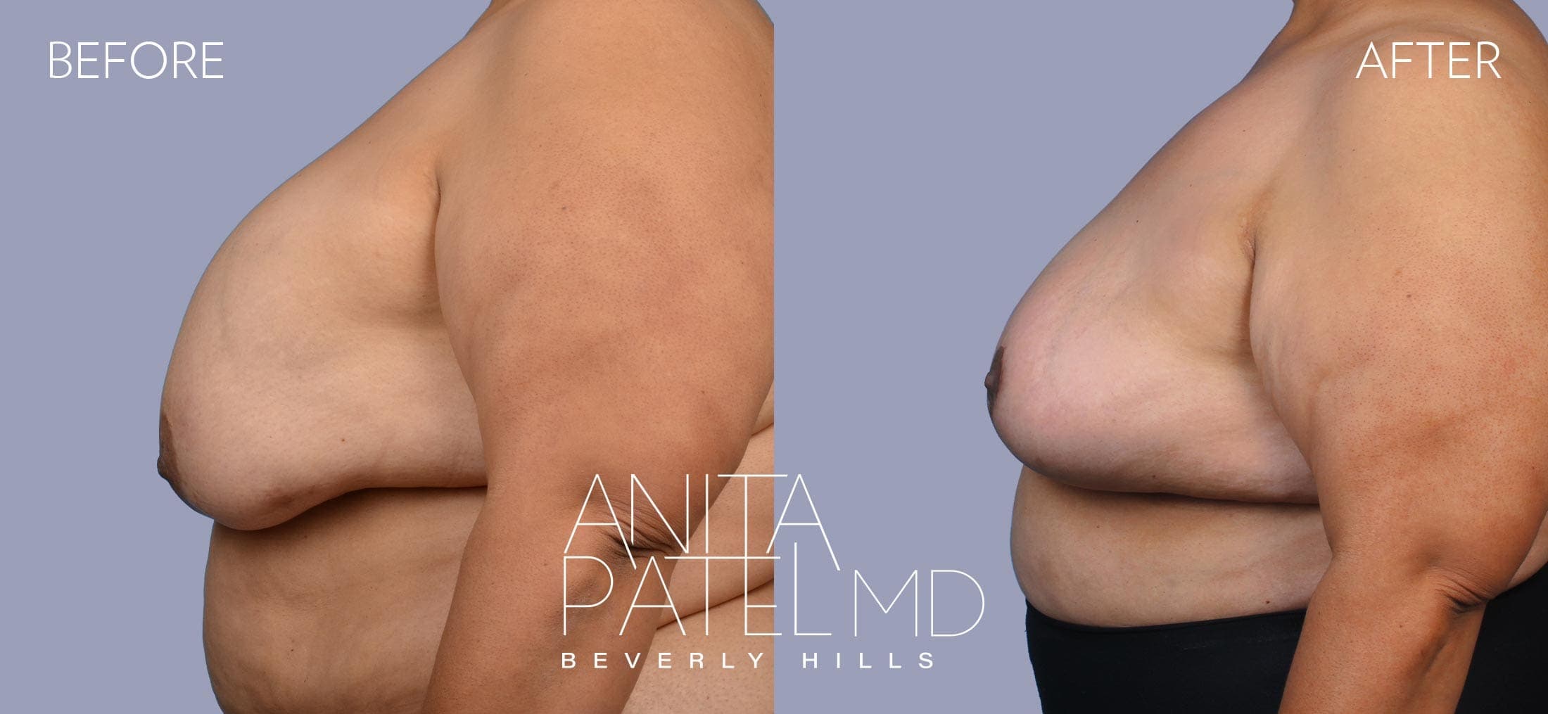 Breast Implant Removal before and after — Patient 2, photo 2 of 5 — Dr. Anita Patel, MD, FACS, Beverly Hills