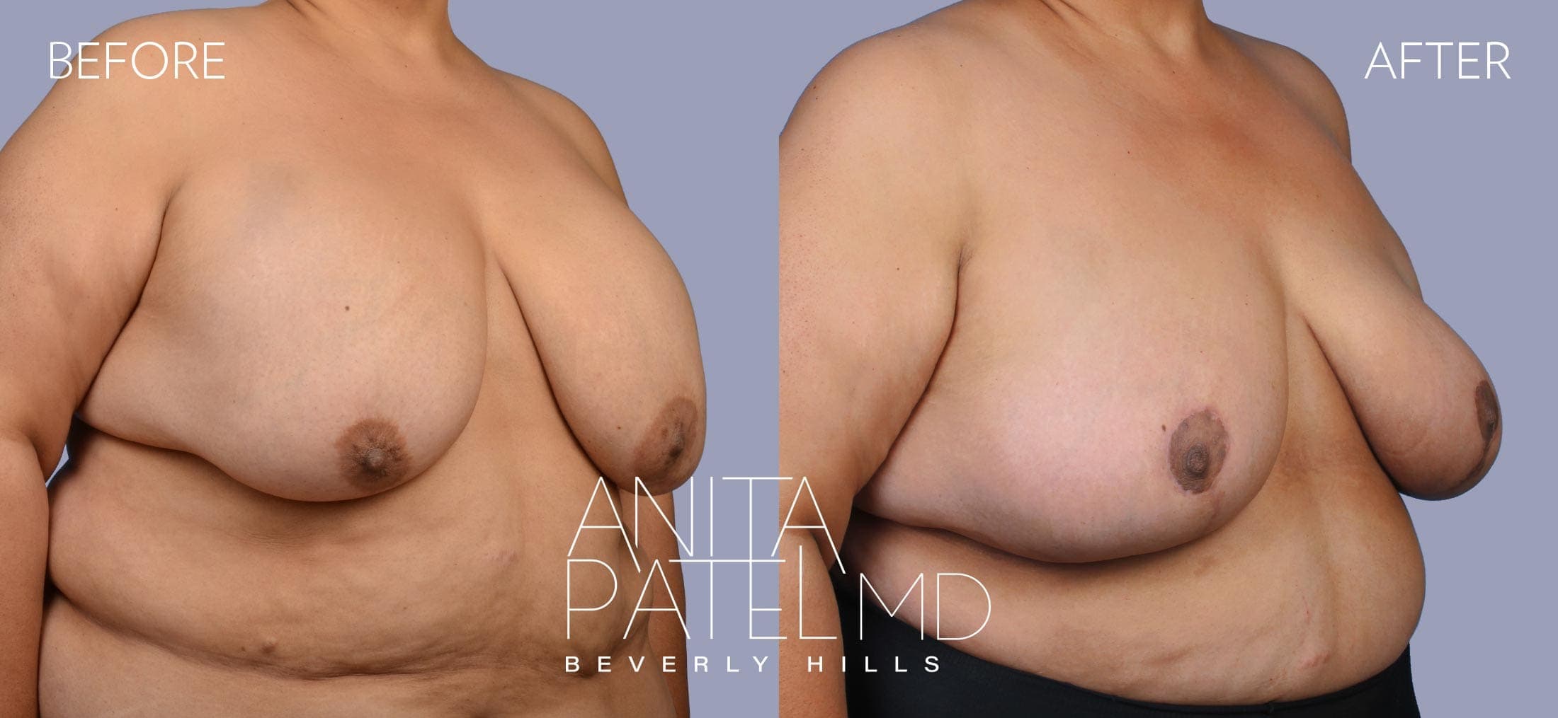 Breast Implant Removal before and after — Patient 2, photo 4 of 5 — Dr. Anita Patel, MD, FACS, Beverly Hills