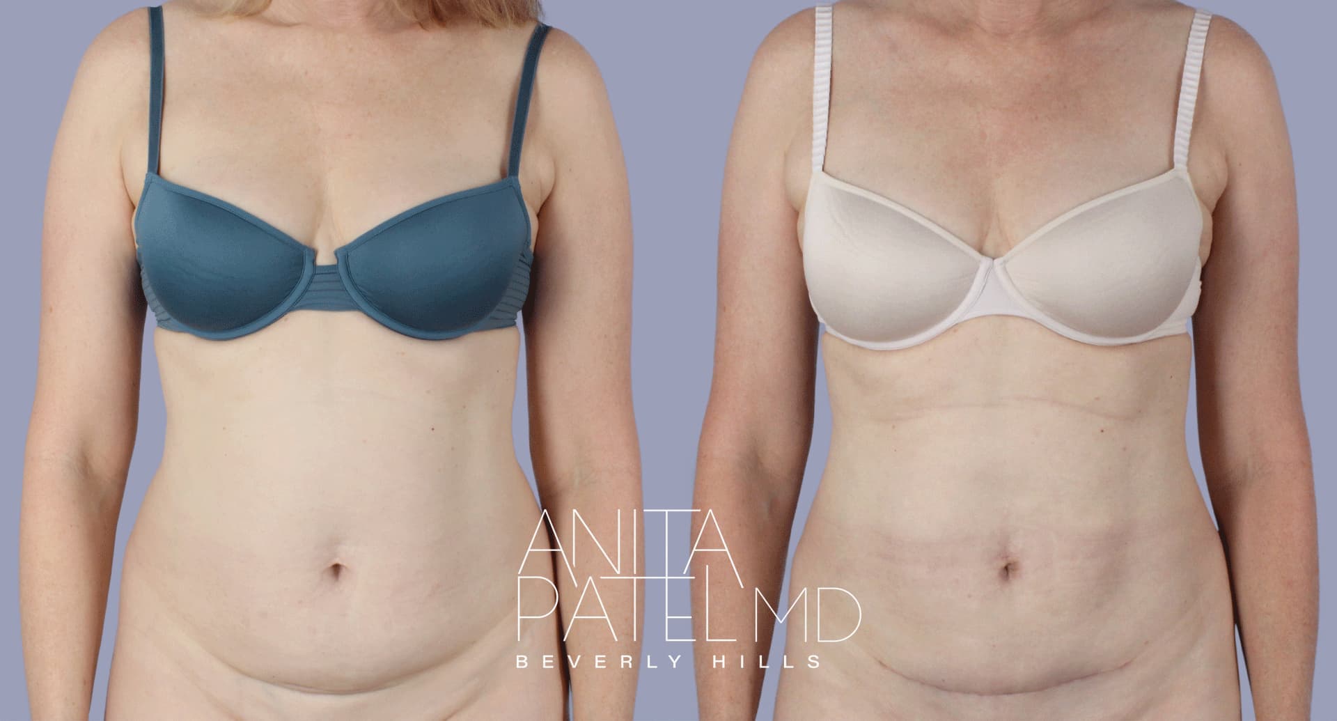Liposuction before and after — Patient 2 — Dr. Anita Patel, MD, FACS, Beverly Hills