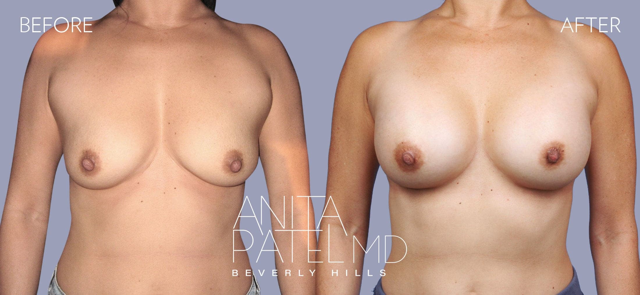 Breast Augmentation before and after — Patient 26, photo 2 of 2 — Dr. Anita Patel, MD, FACS, Beverly Hills