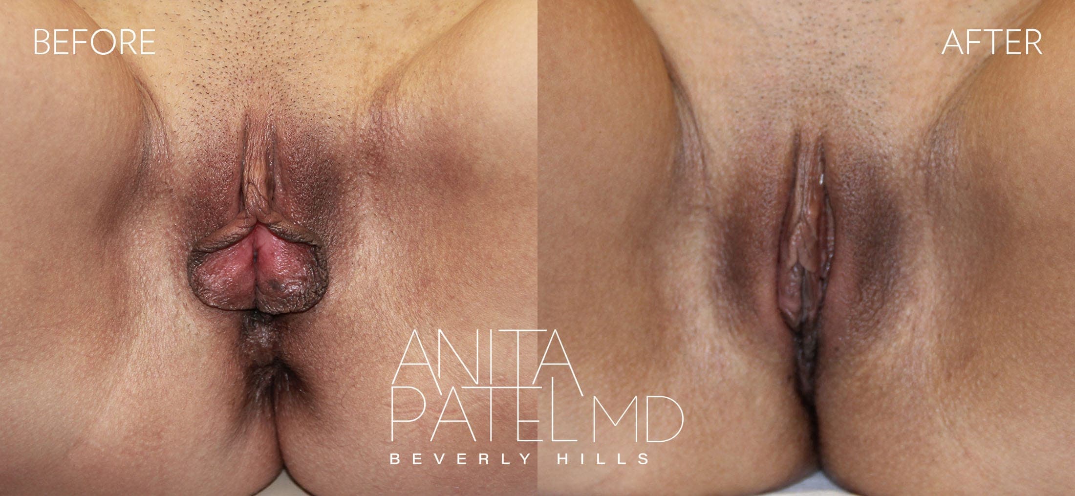 Labiaplasty before and after — Patient 1 — Dr. Anita Patel, MD, FACS, Beverly Hills