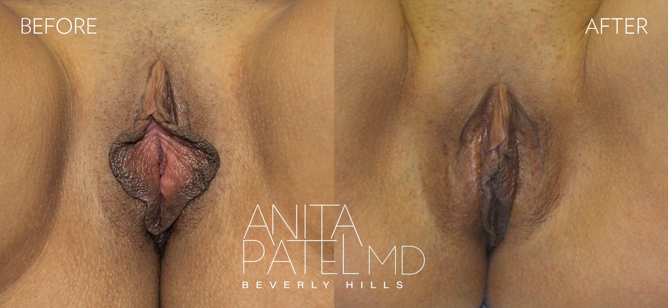 Labiaplasty before and after — Patient 2 — Dr. Anita Patel, MD, FACS, Beverly Hills