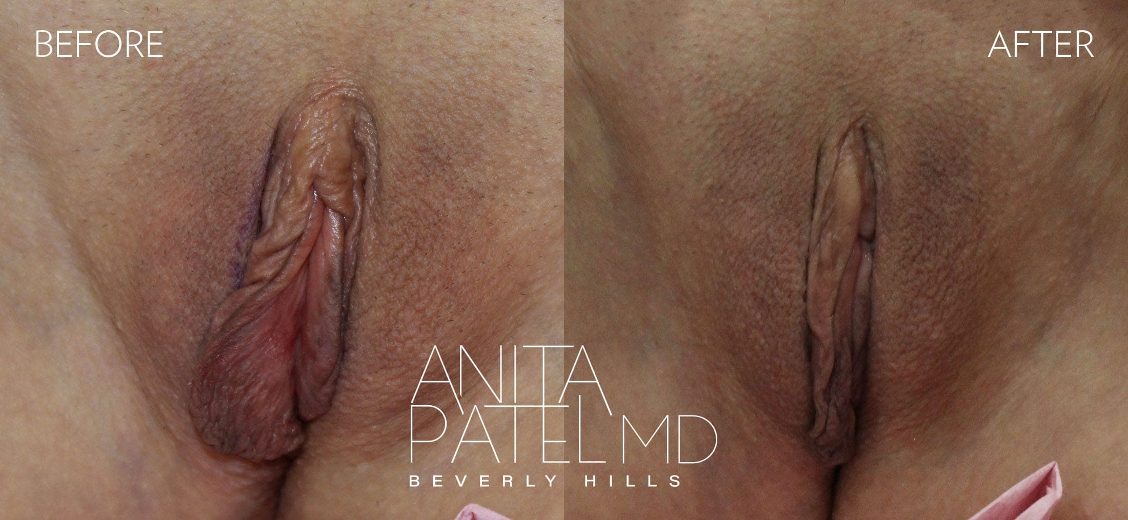Labiaplasty before and after — Patient 4 — Dr. Anita Patel, MD, FACS, Beverly Hills