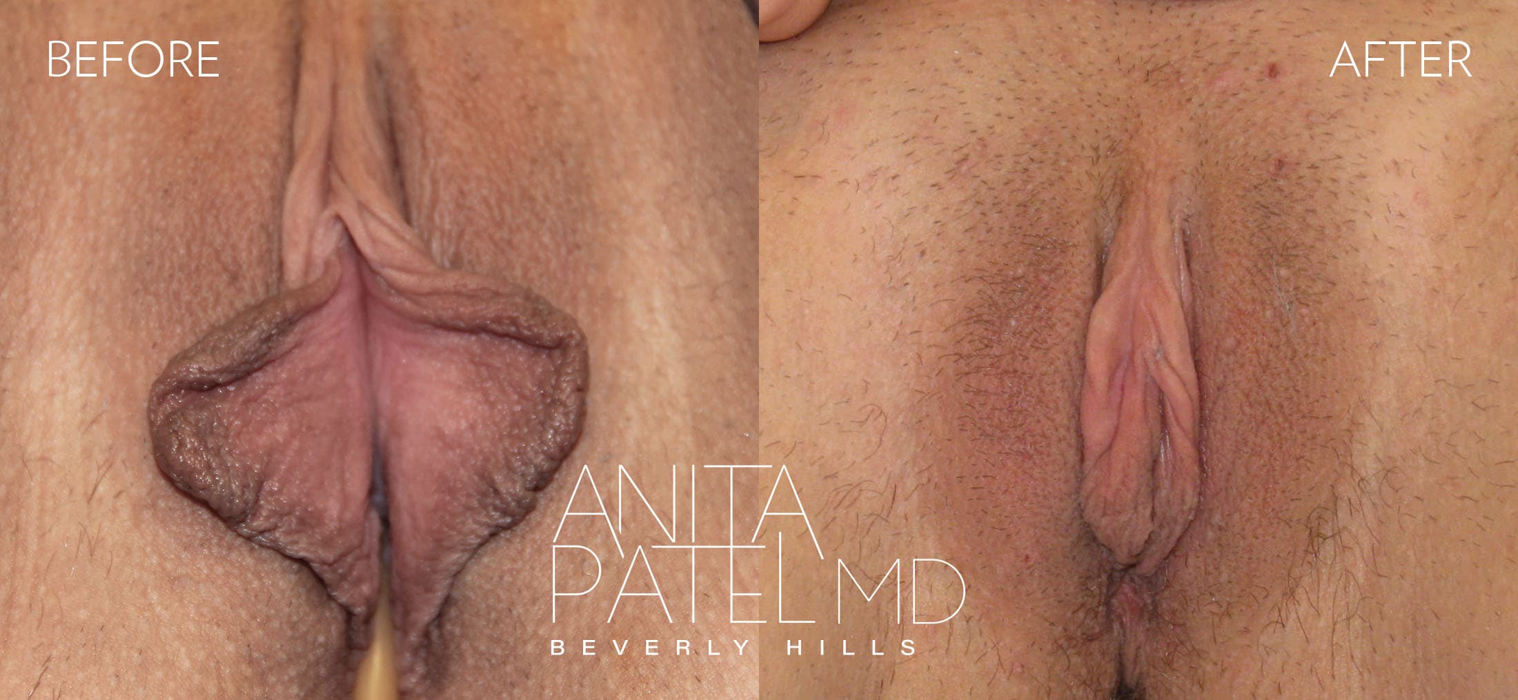 Labiaplasty before and after — Patient 5 — Dr. Anita Patel, MD, FACS, Beverly Hills