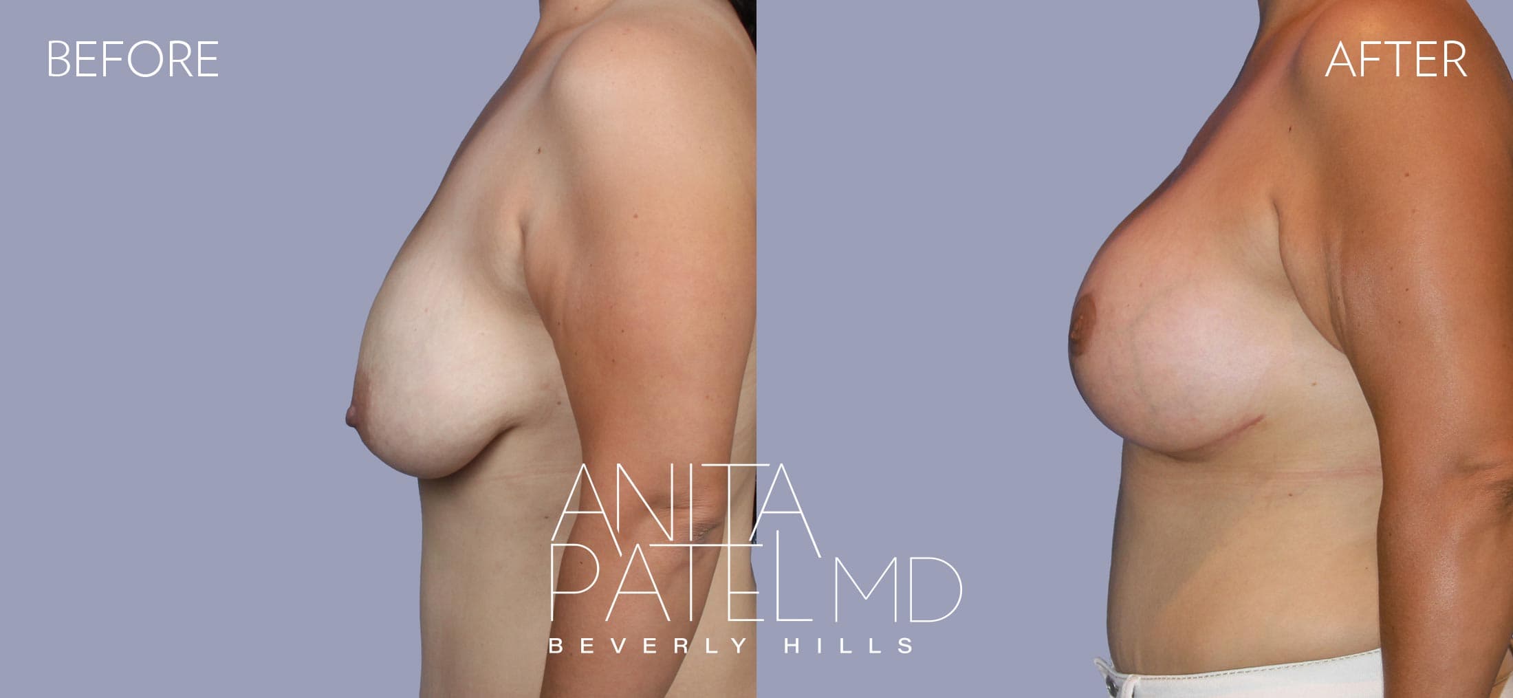 Breast Augmentation with Lift before and after — Patient 7, photo 5 of 5 — Dr. Anita Patel, MD, FACS, Beverly Hills