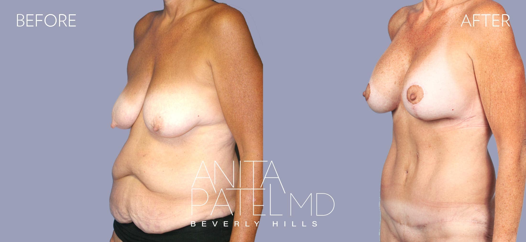 Breast Augmentation with Lift before and after — Patient 8, photo 3 of 3 — Dr. Anita Patel, MD, FACS, Beverly Hills