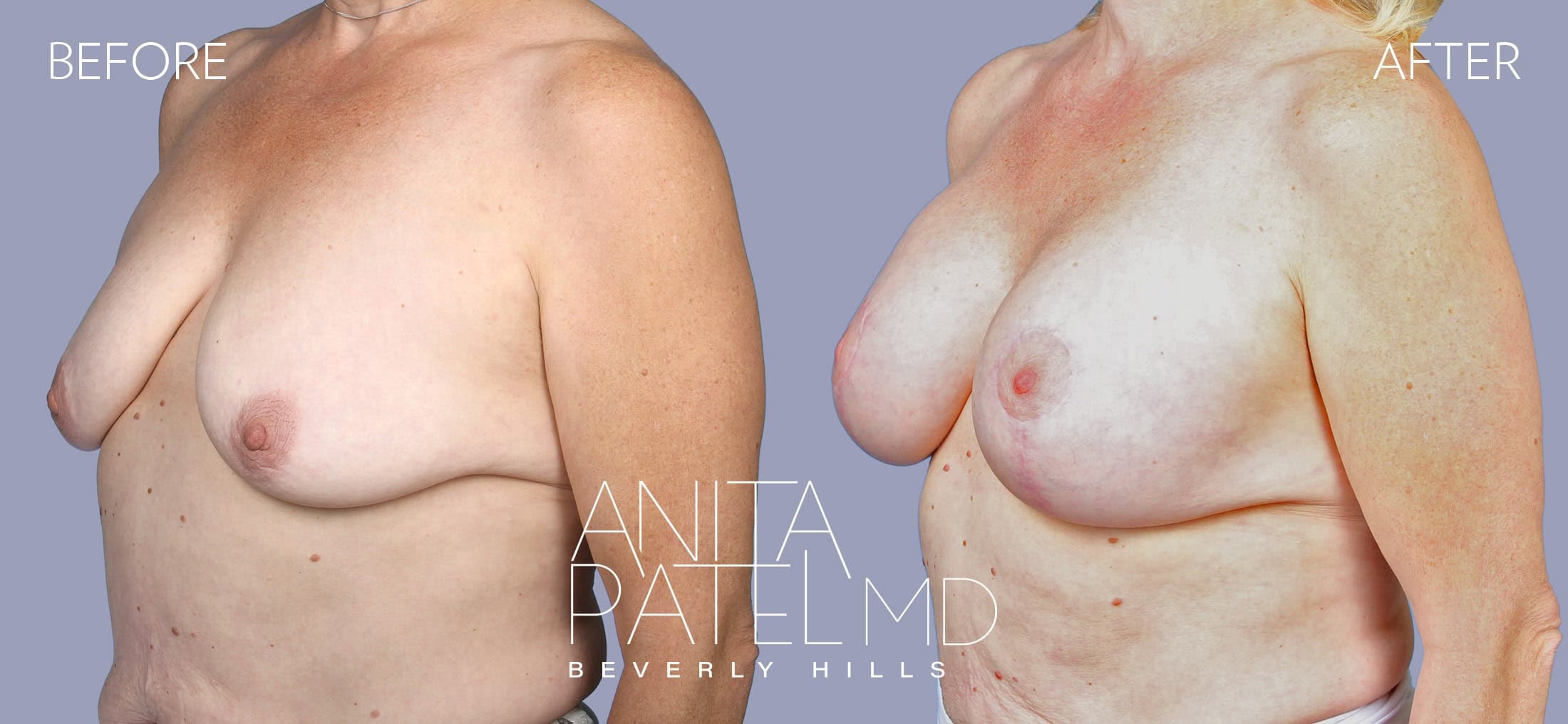 Breast Augmentation with Lift before and after — Patient 9 — Dr. Anita Patel, MD, FACS, Beverly Hills