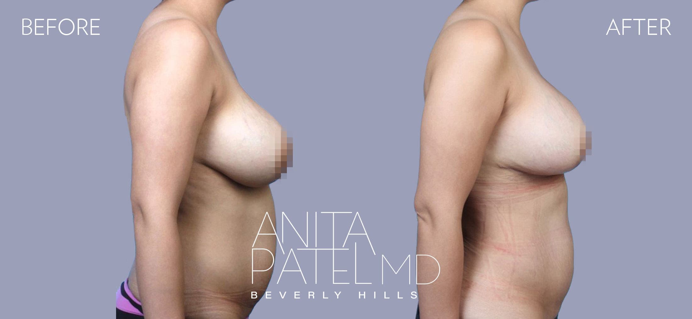Liposuction before and after — Patient 11, photo 5 of 5 — Dr. Anita Patel, MD, FACS, Beverly Hills