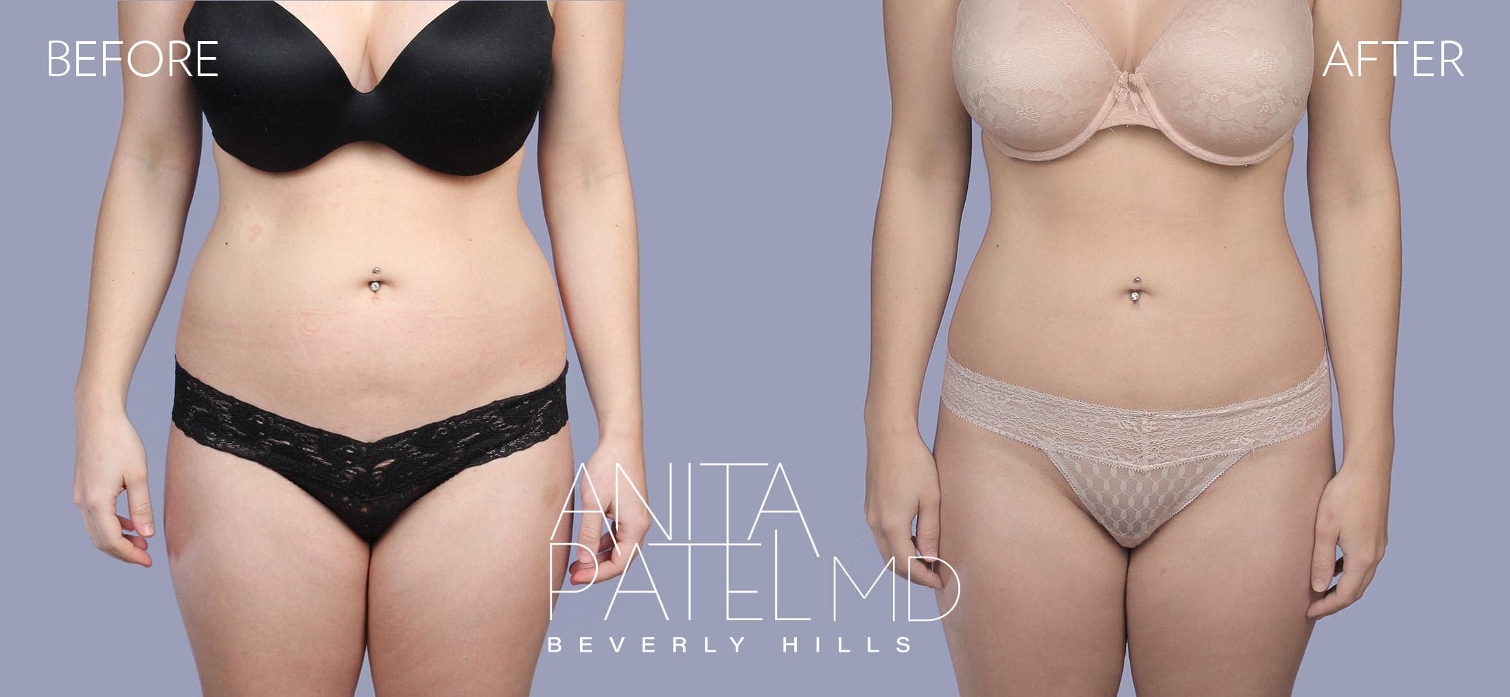 Liposuction before and after — Patient 2, photo 1 of 6 — Dr. Anita Patel, MD, FACS, Beverly Hills