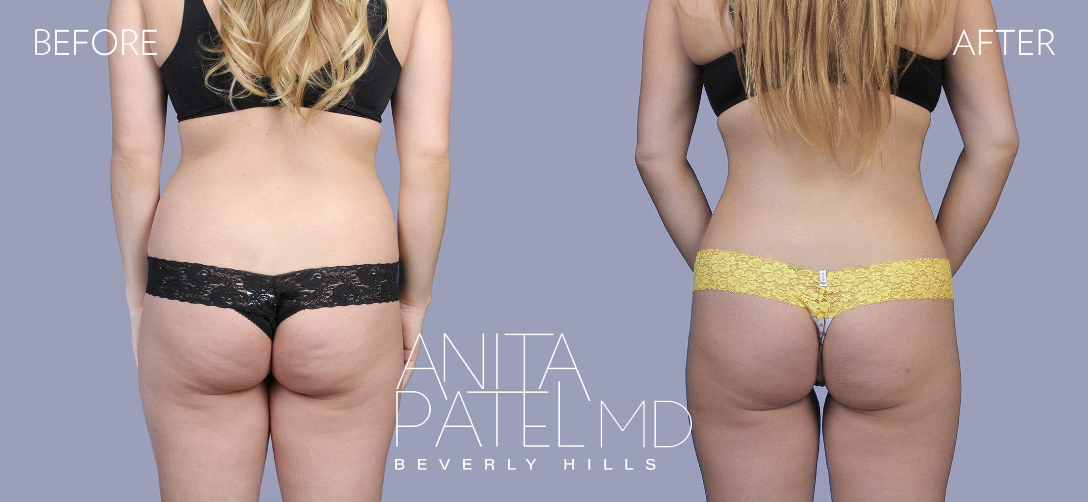 Liposuction before and after — Patient 2, photo 2 of 6 — Dr. Anita Patel, MD, FACS, Beverly Hills