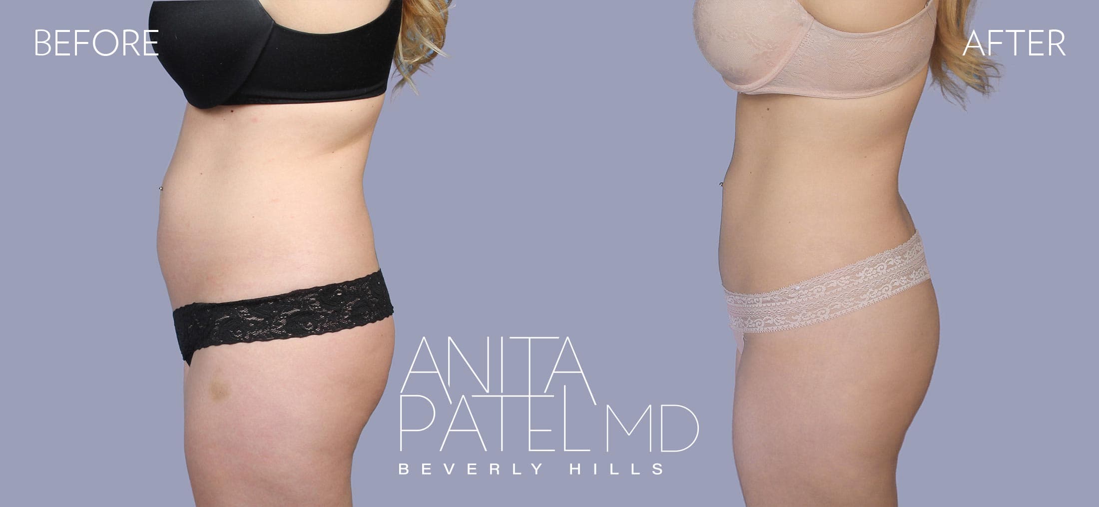 Liposuction before and after — Patient 2, photo 3 of 6 — Dr. Anita Patel, MD, FACS, Beverly Hills
