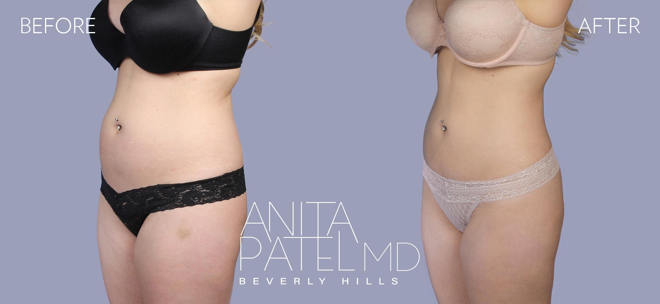 Liposuction before and after — Patient 2, photo 4 of 6 — Dr. Anita Patel, MD, FACS, Beverly Hills