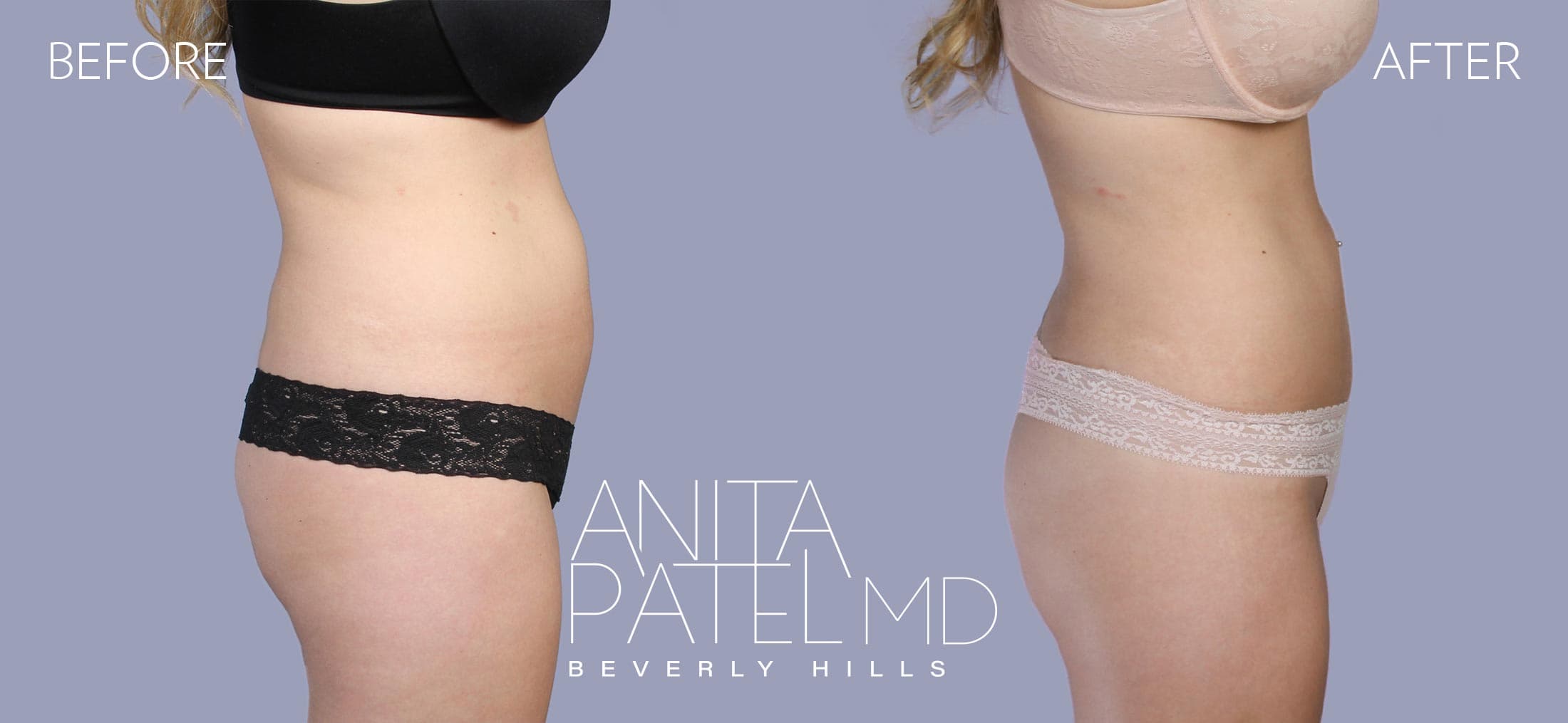 Liposuction before and after — Patient 2, photo 5 of 6 — Dr. Anita Patel, MD, FACS, Beverly Hills