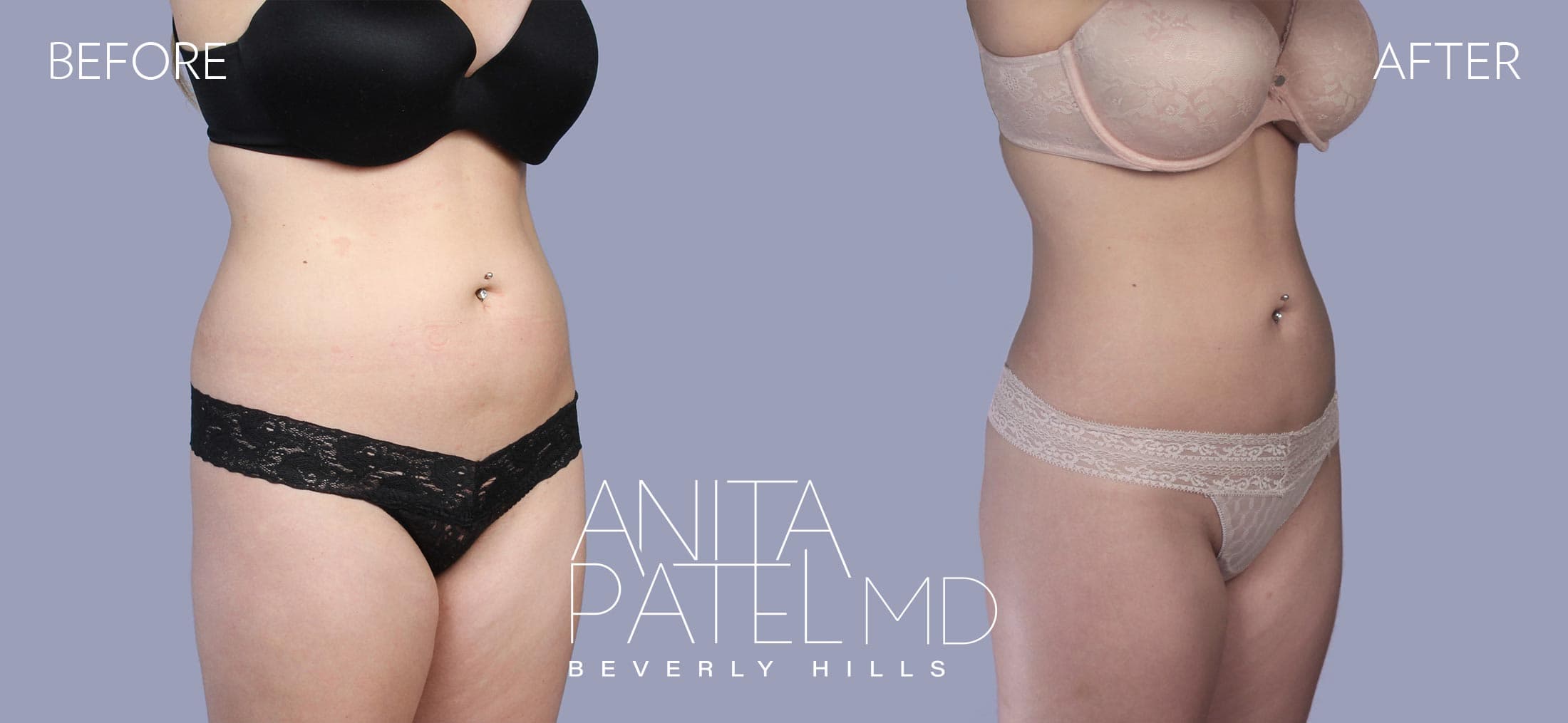 Liposuction before and after — Patient 2, photo 6 of 6 — Dr. Anita Patel, MD, FACS, Beverly Hills