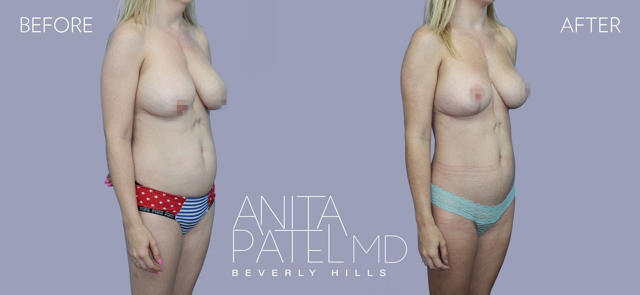 Liposuction before and after — Patient 4, photo 2 of 5 — Dr. Anita Patel, MD, FACS, Beverly Hills