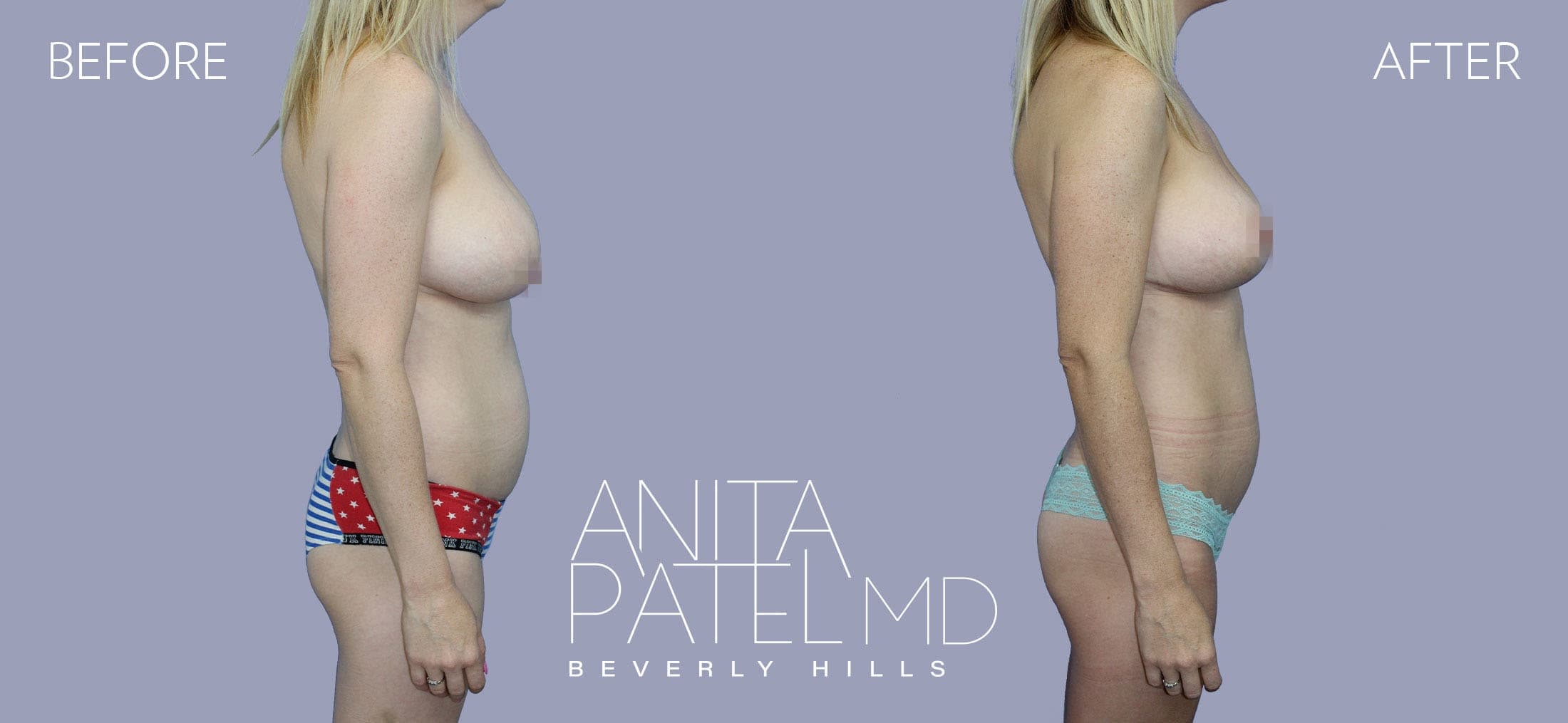 Liposuction before and after — Patient 4, photo 3 of 5 — Dr. Anita Patel, MD, FACS, Beverly Hills