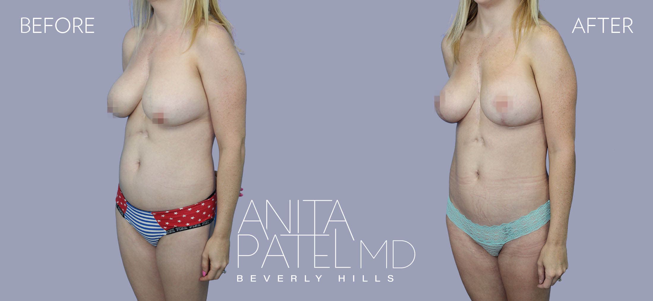 Liposuction before and after — Patient 4, photo 4 of 5 — Dr. Anita Patel, MD, FACS, Beverly Hills