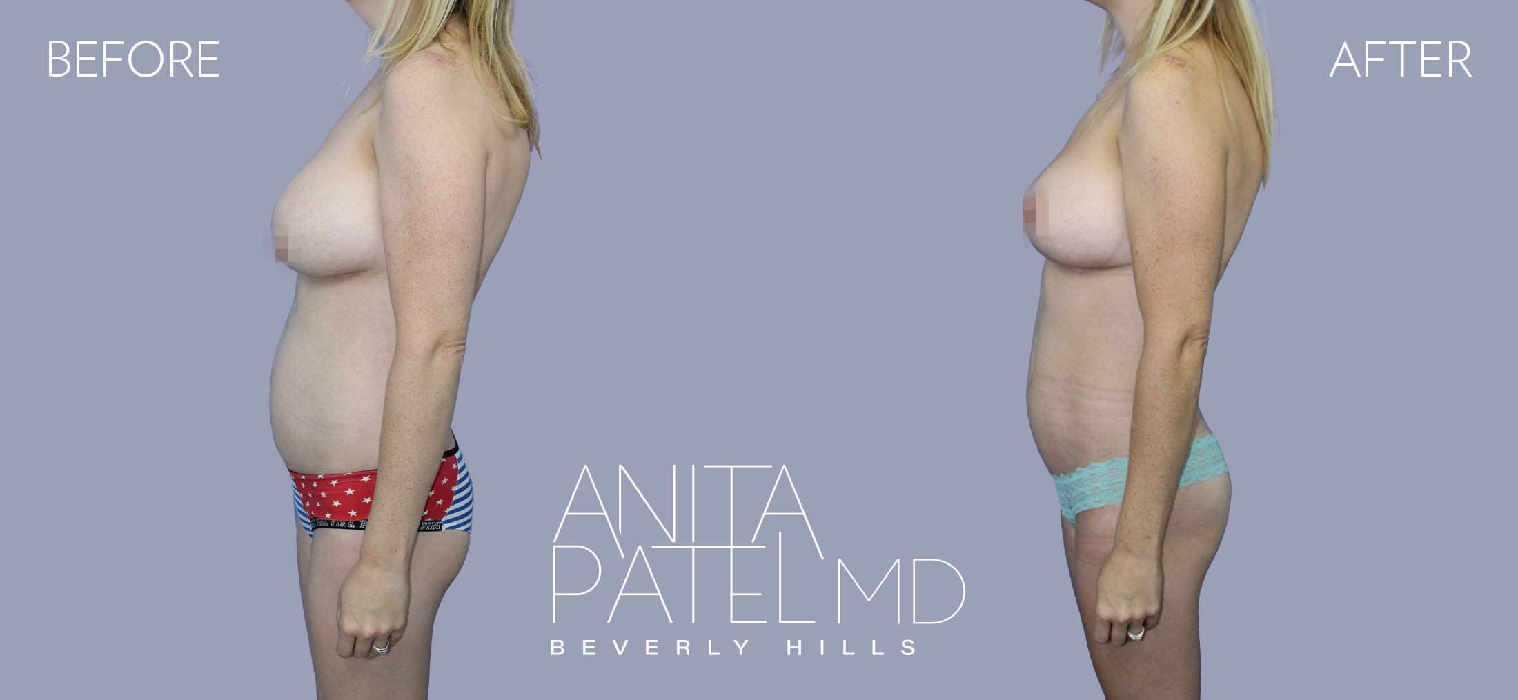 Liposuction before and after — Patient 4, photo 5 of 5 — Dr. Anita Patel, MD, FACS, Beverly Hills