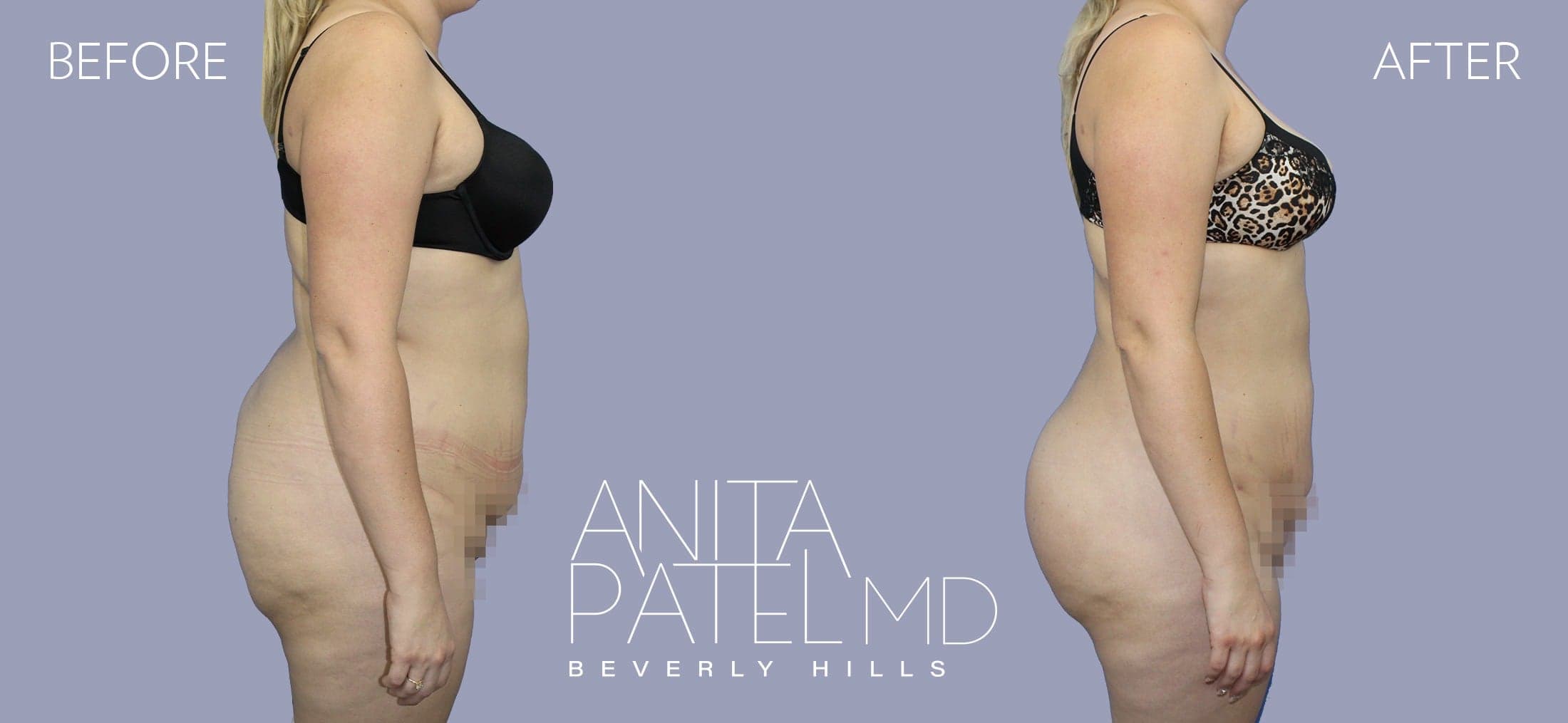 Liposuction before and after — Patient 12, photo 3 of 4 — Dr. Anita Patel, MD, FACS, Beverly Hills