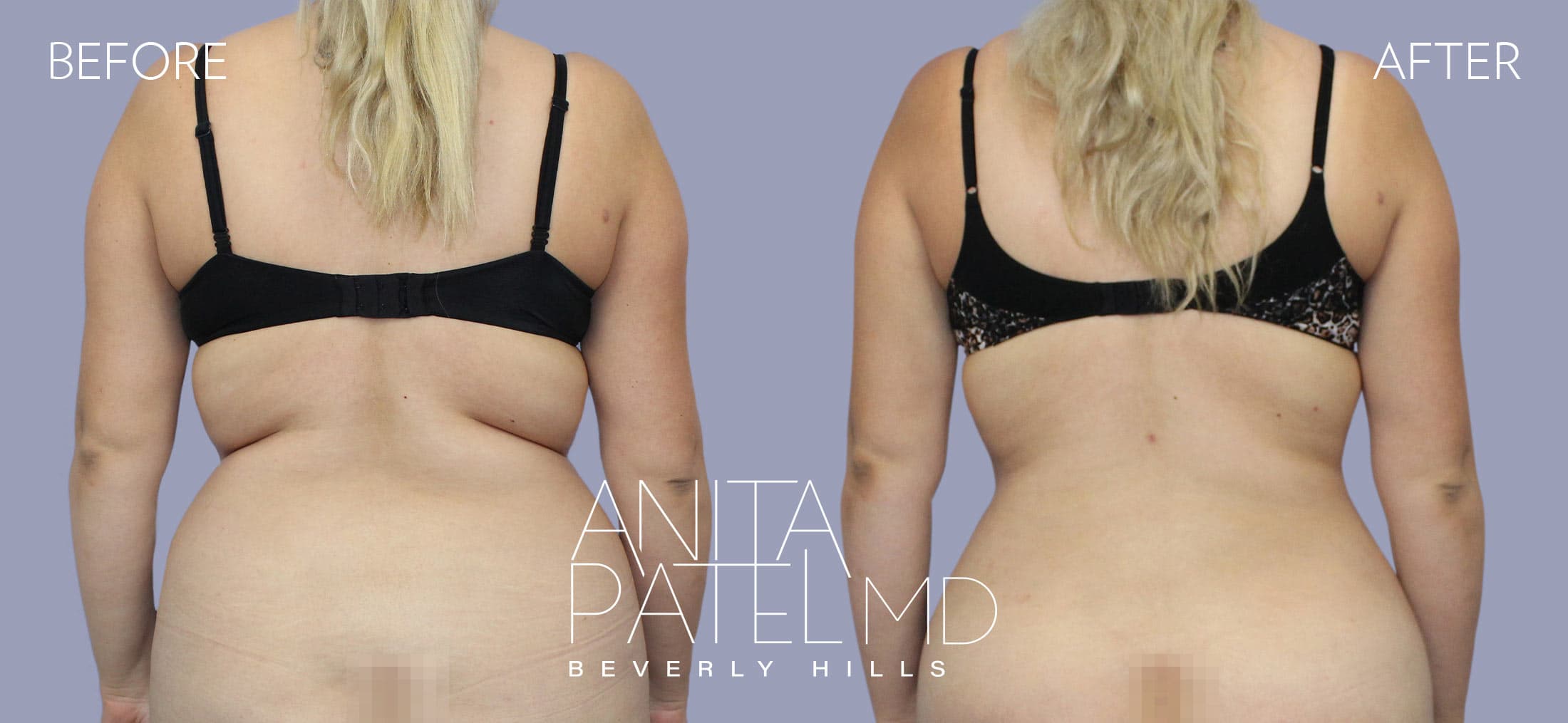 Liposuction before and after — Patient 5, photo 1 of 3 — Dr. Anita Patel, MD, FACS, Beverly Hills