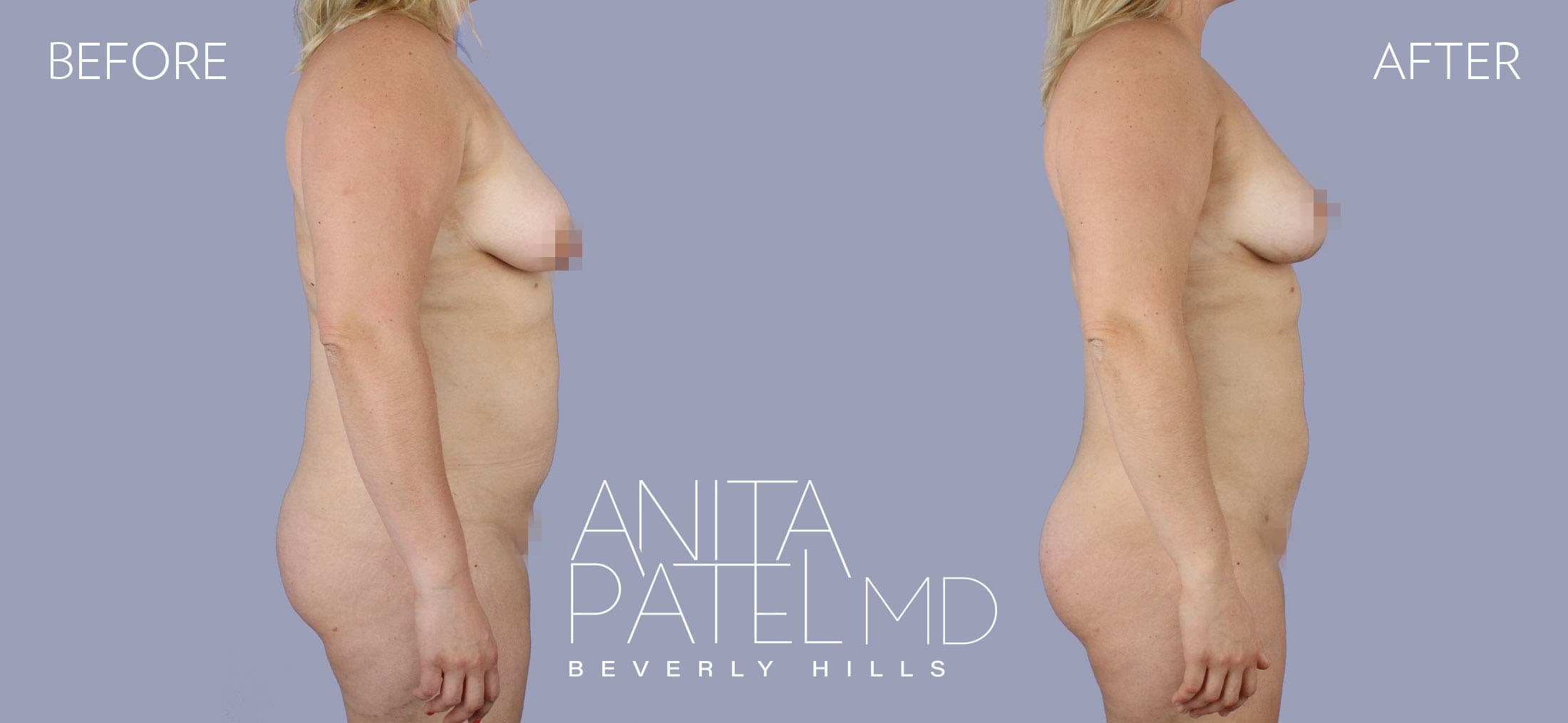 Liposuction before and after — Patient 6, photo 3 of 6 — Dr. Anita Patel, MD, FACS, Beverly Hills