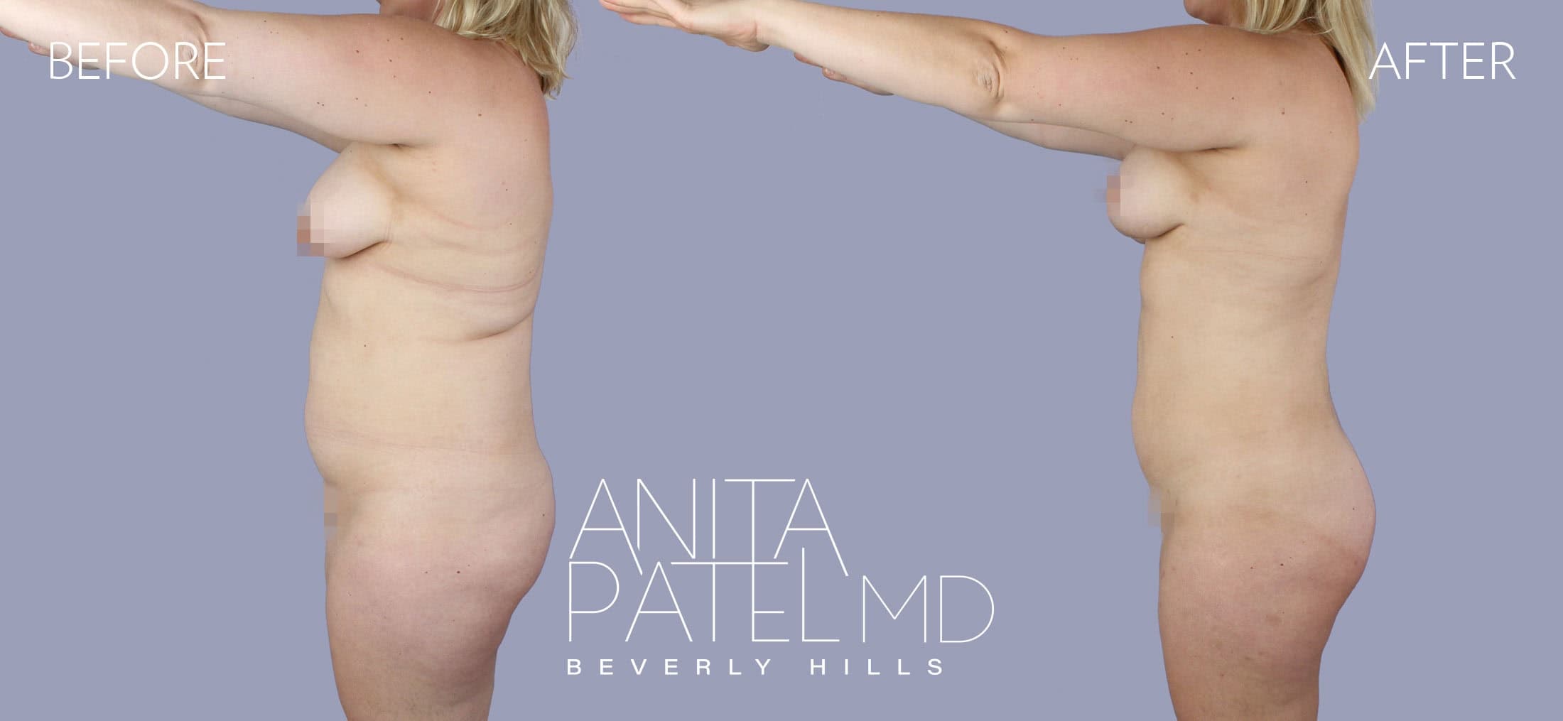 Liposuction before and after — Patient 6, photo 5 of 6 — Dr. Anita Patel, MD, FACS, Beverly Hills