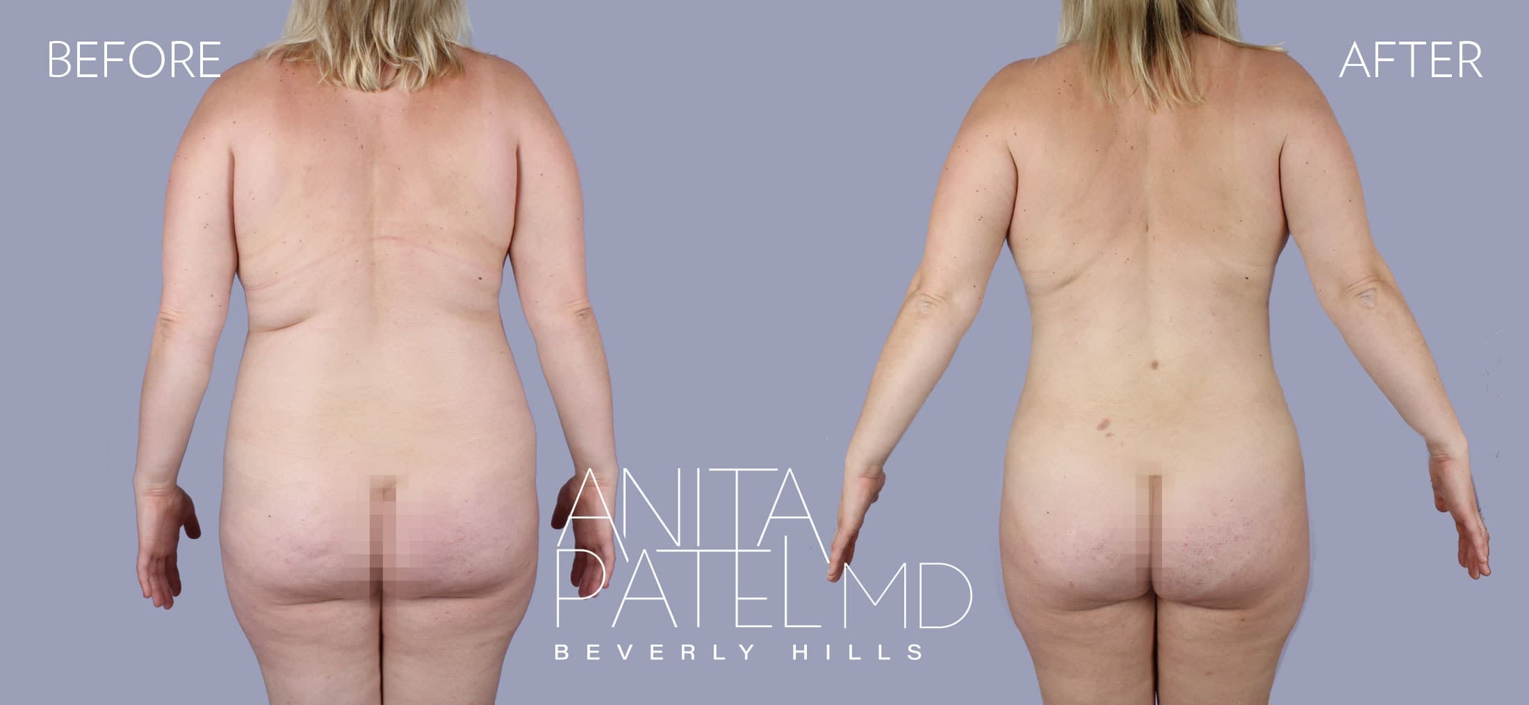Liposuction before and after — Patient 6, photo 6 of 6 — Dr. Anita Patel, MD, FACS, Beverly Hills