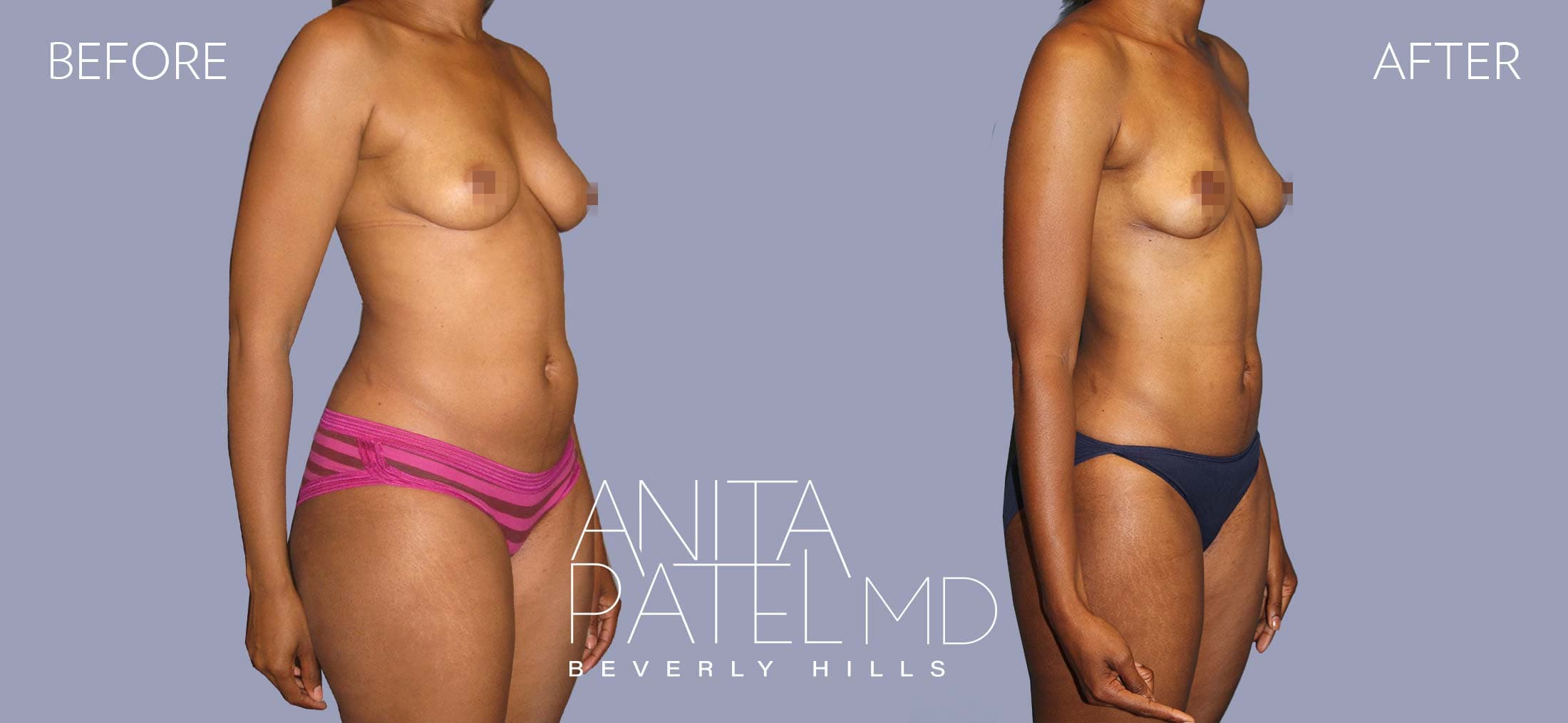 Liposuction before and after — Patient 8, photo 2 of 6 — Dr. Anita Patel, MD, FACS, Beverly Hills