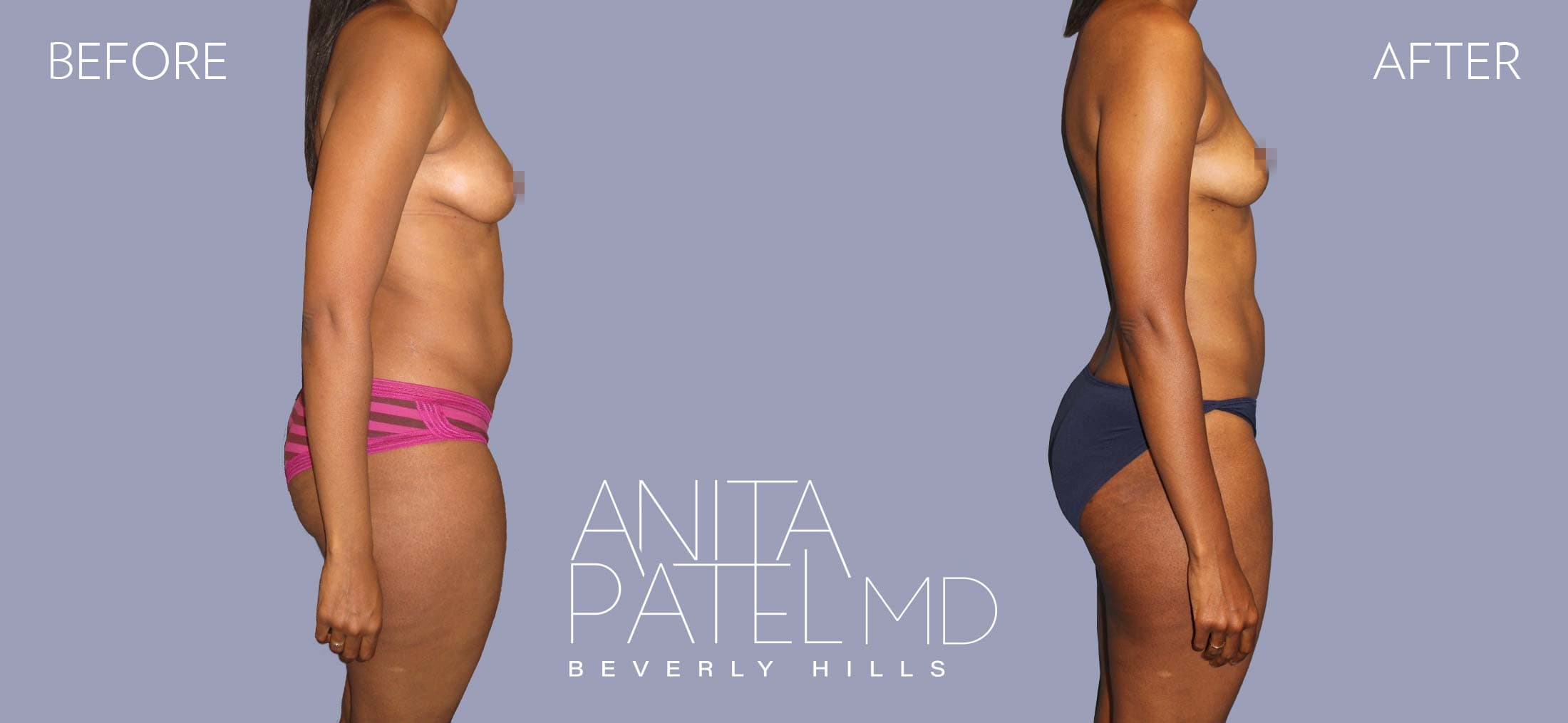 Liposuction before and after — Patient 8, photo 3 of 6 — Dr. Anita Patel, MD, FACS, Beverly Hills